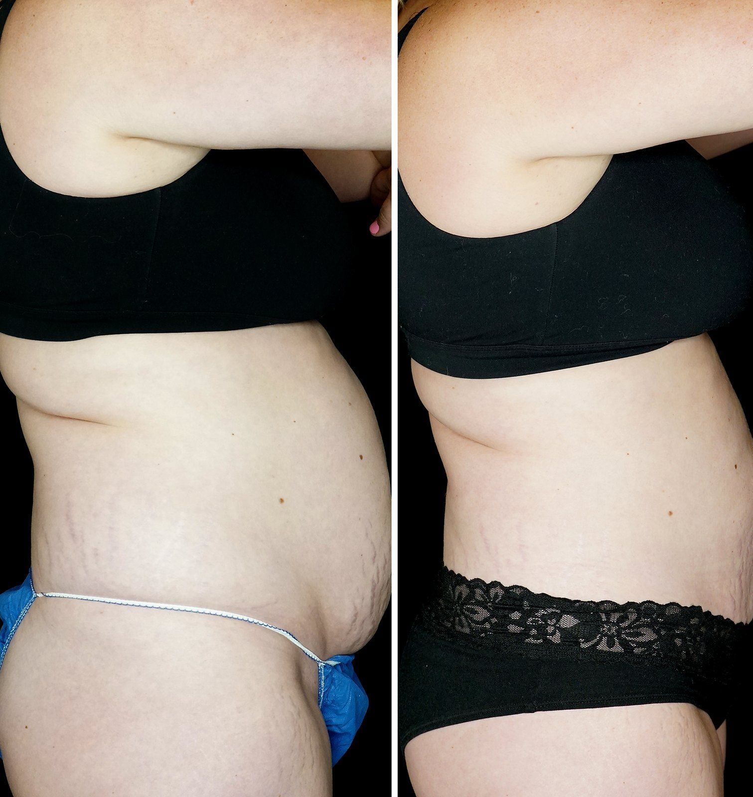 Before and after SenzaLipo: Abdomen. Before on the top, after on the bottom.