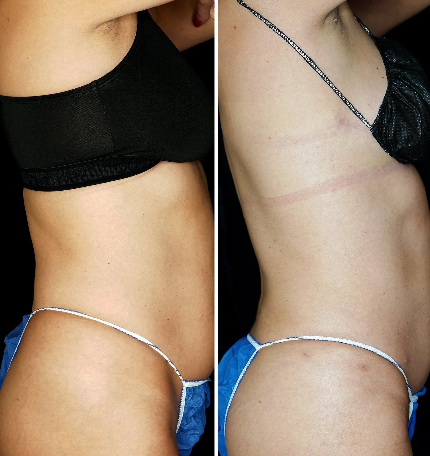 Before and after SenzaLipo: Abdomen. Before on the top, after on the bottom.