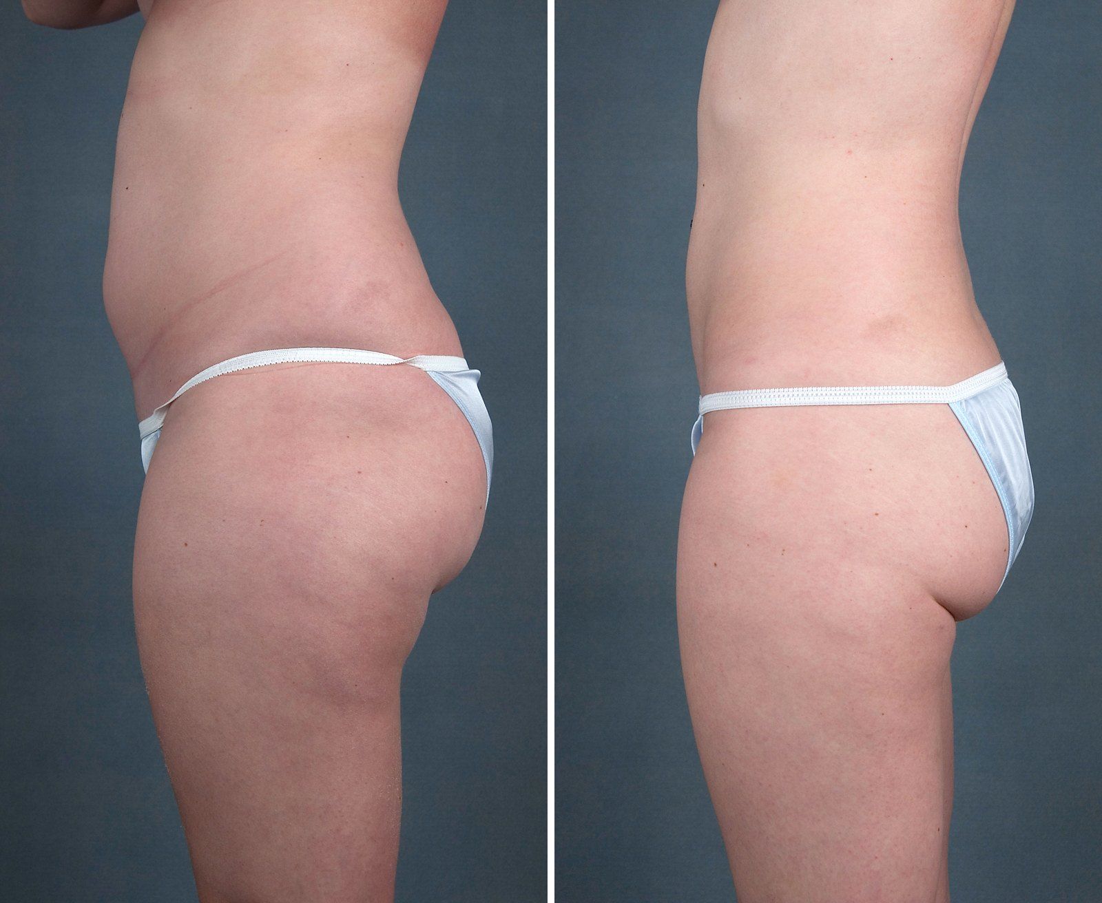 Before and after SenzaLipo: Thighs & abdomen. Before on the left, after on the right.