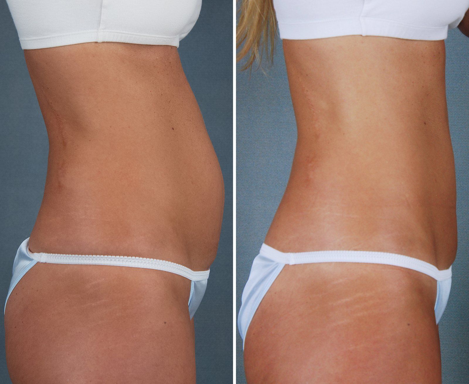 Before and after SenzaLipo: Abdomen. Before on the left, after on the right.