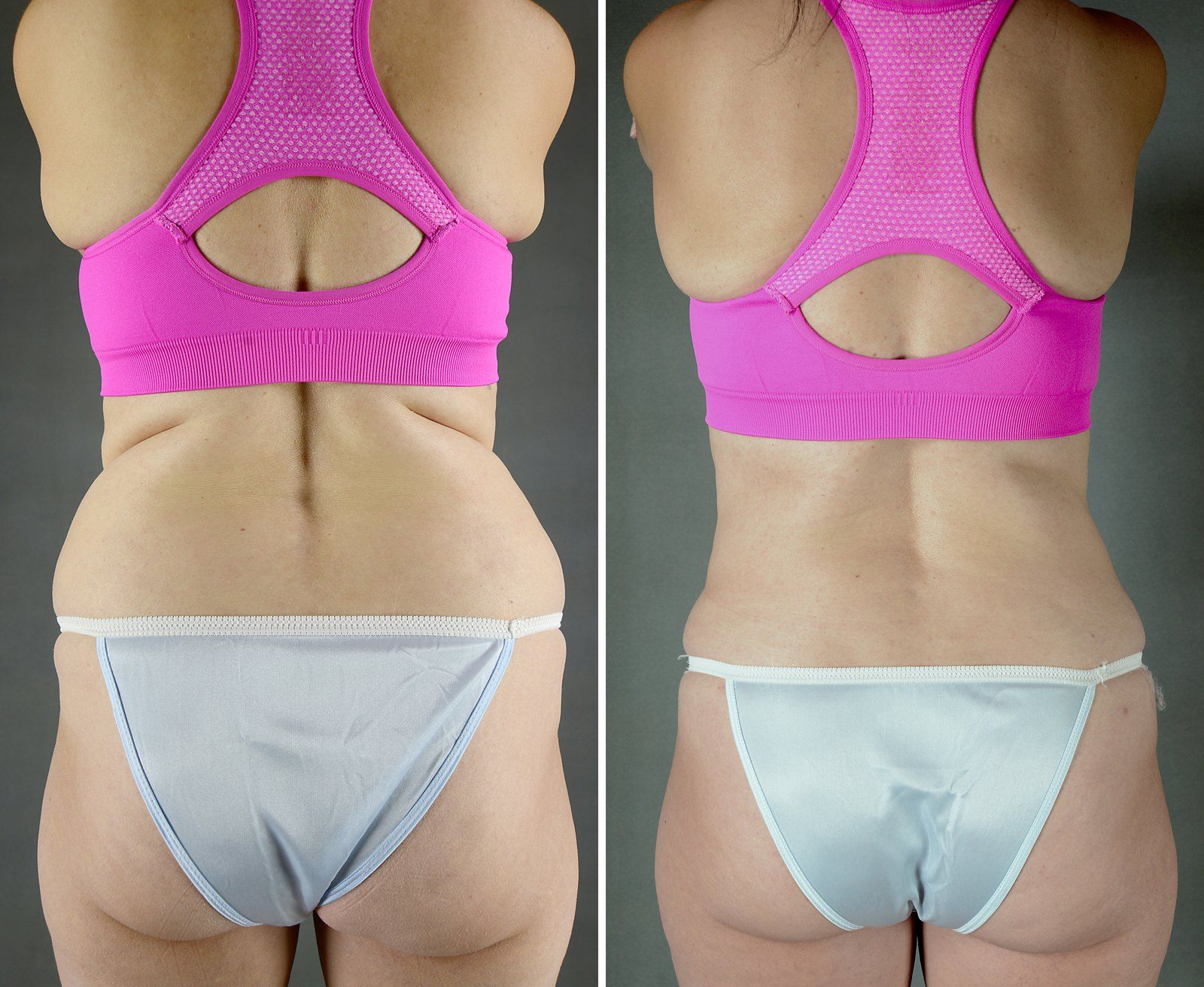 Before and after SenzaLipo: Back & flanks. Before on the left, after on the right.