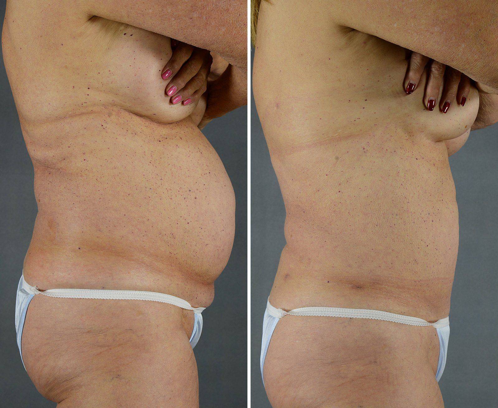 Before and after SenzaLipo: Abdomen & flanks. Before on the left, after on the right.