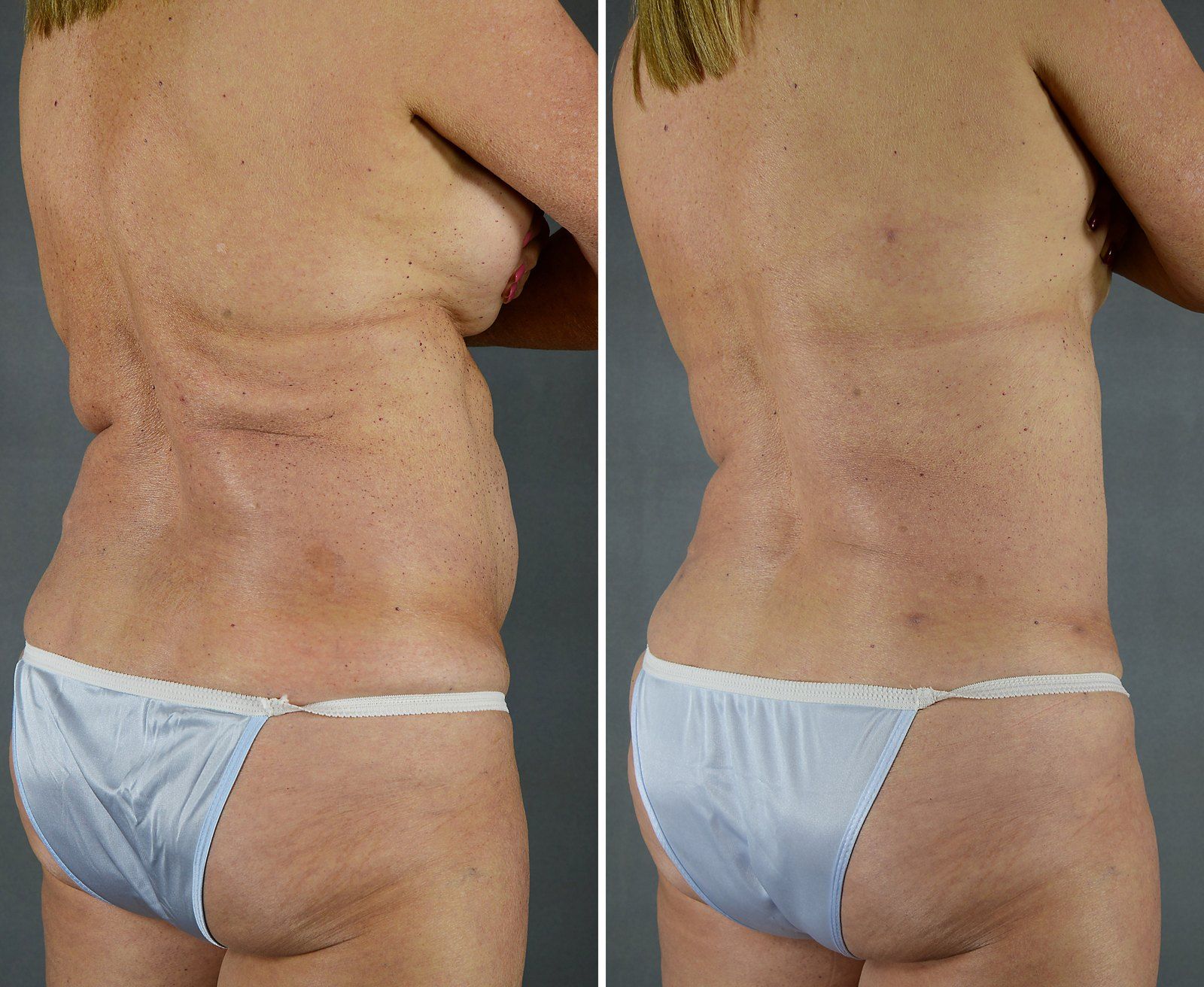 Before and after SenzaLipo: Back & flanks. Before on the left, after on the right.