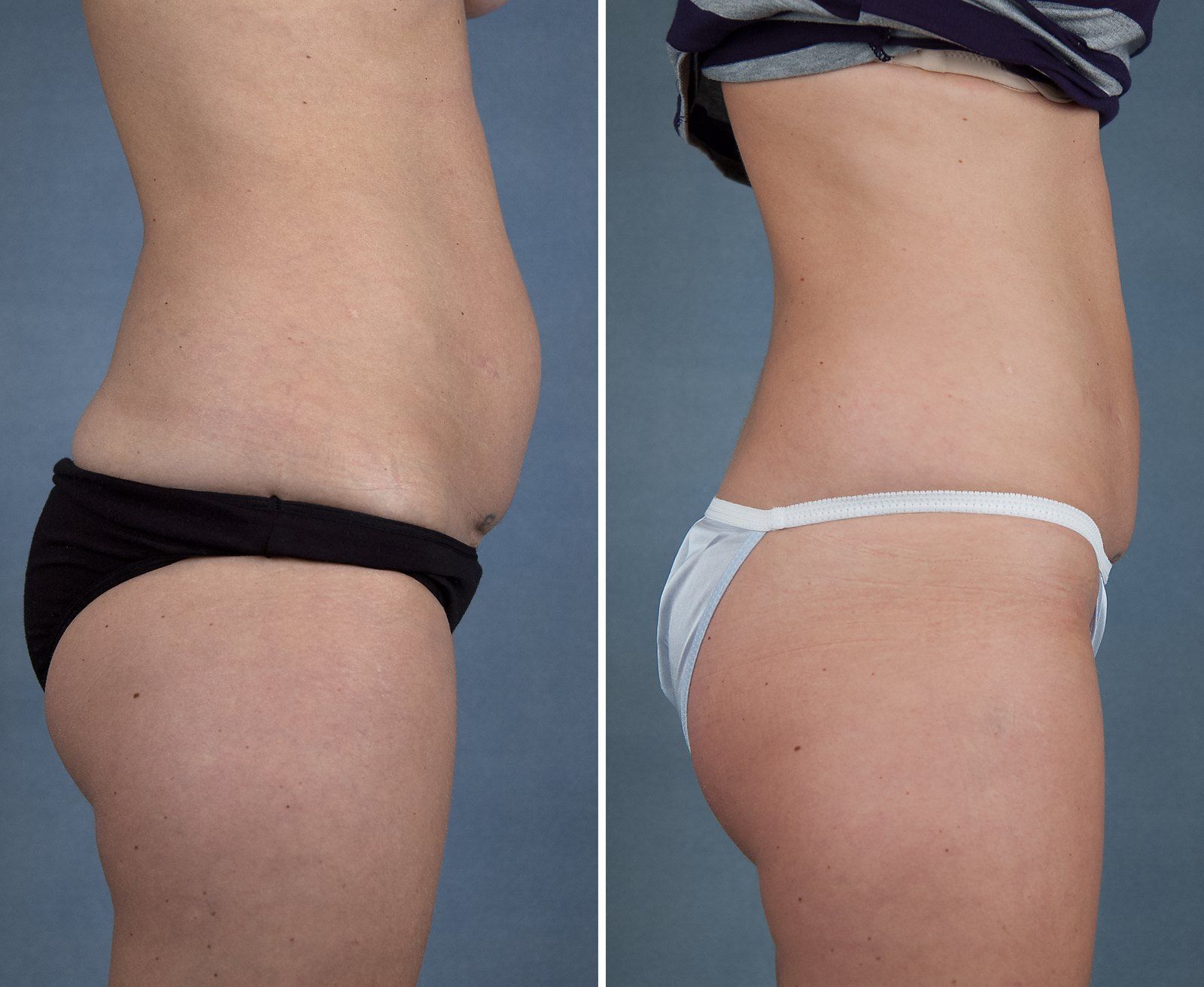 Before and after SenzaLipo: Abdomen & flanks. Before on the left, after on the right.