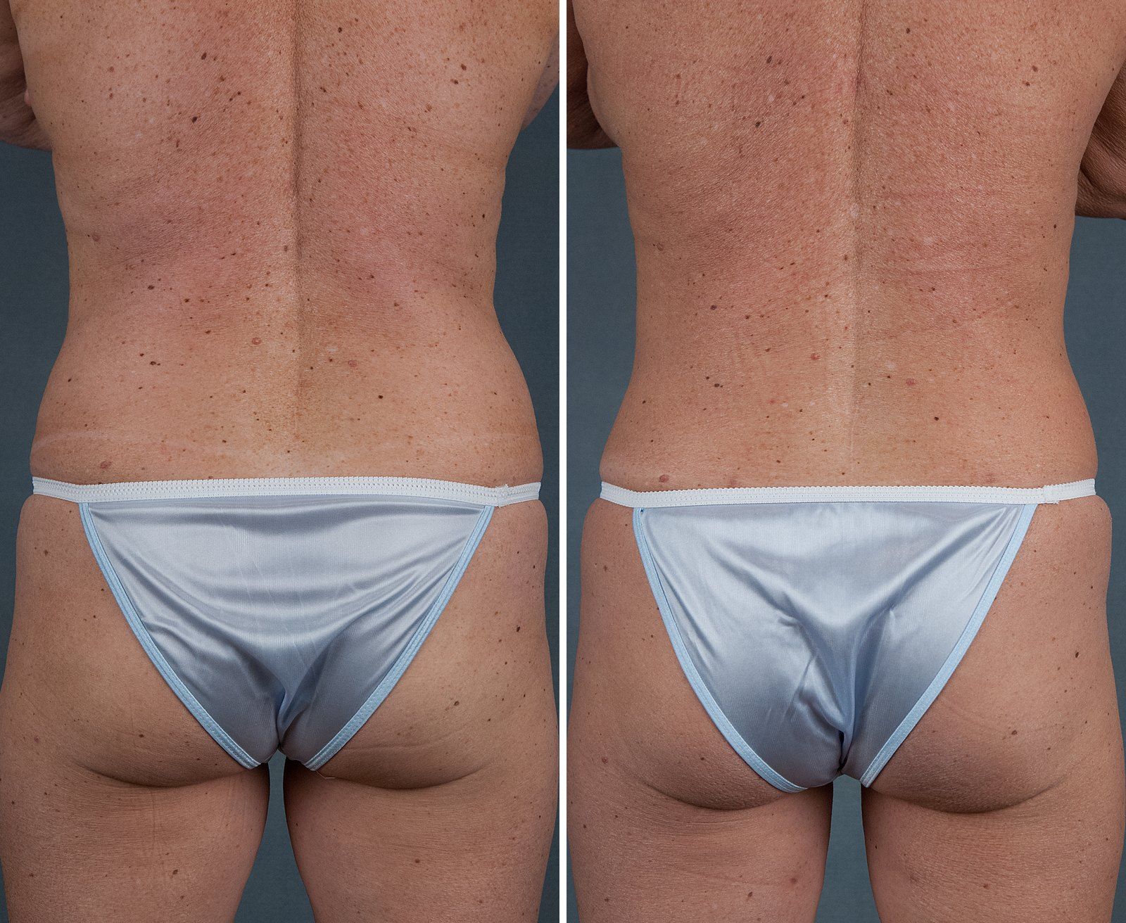 Before and after SenzaLipo: Back & flanks. Before on the left, after on the right.