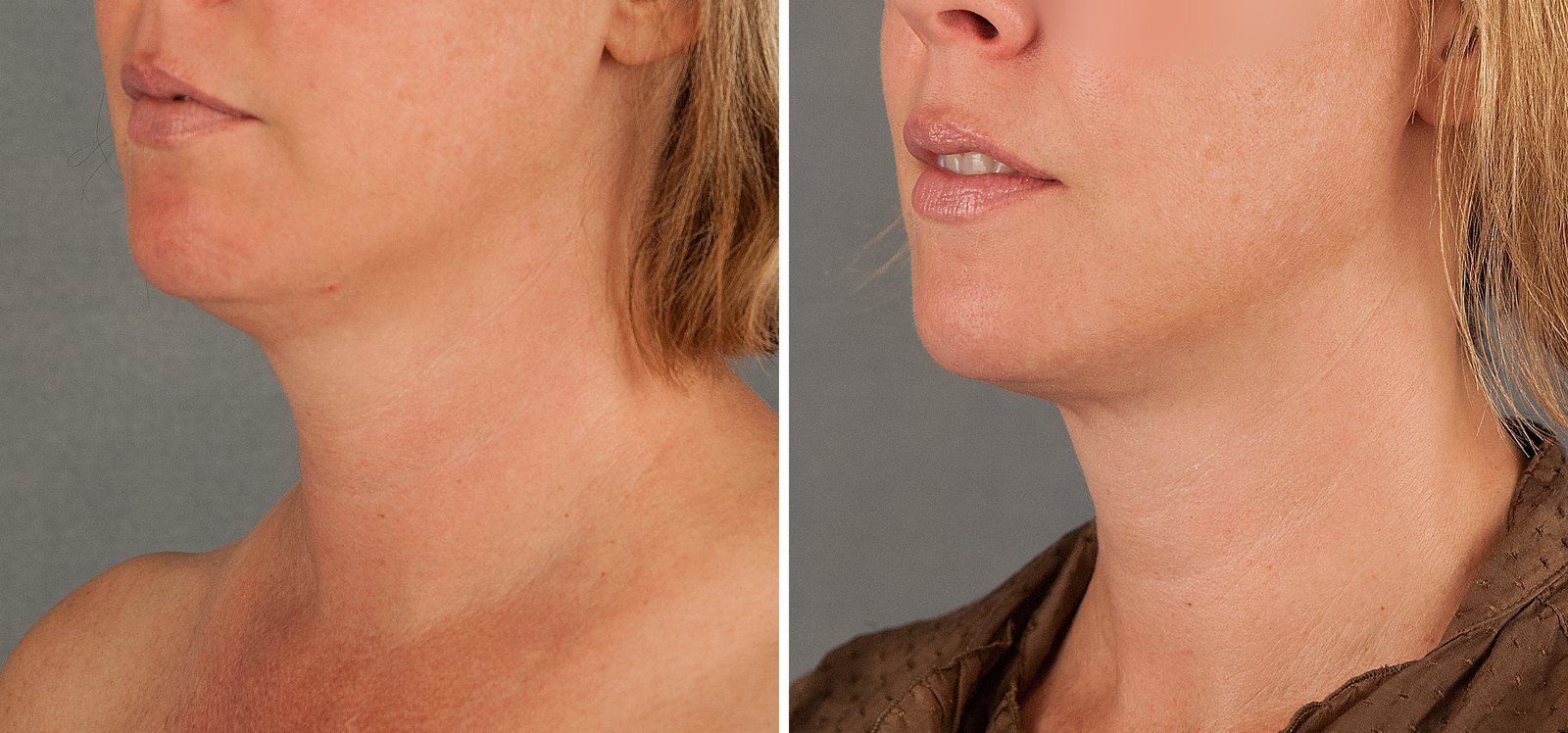 Before and after SenzaLipo: Chin & neck. Before on the left, after on the right.