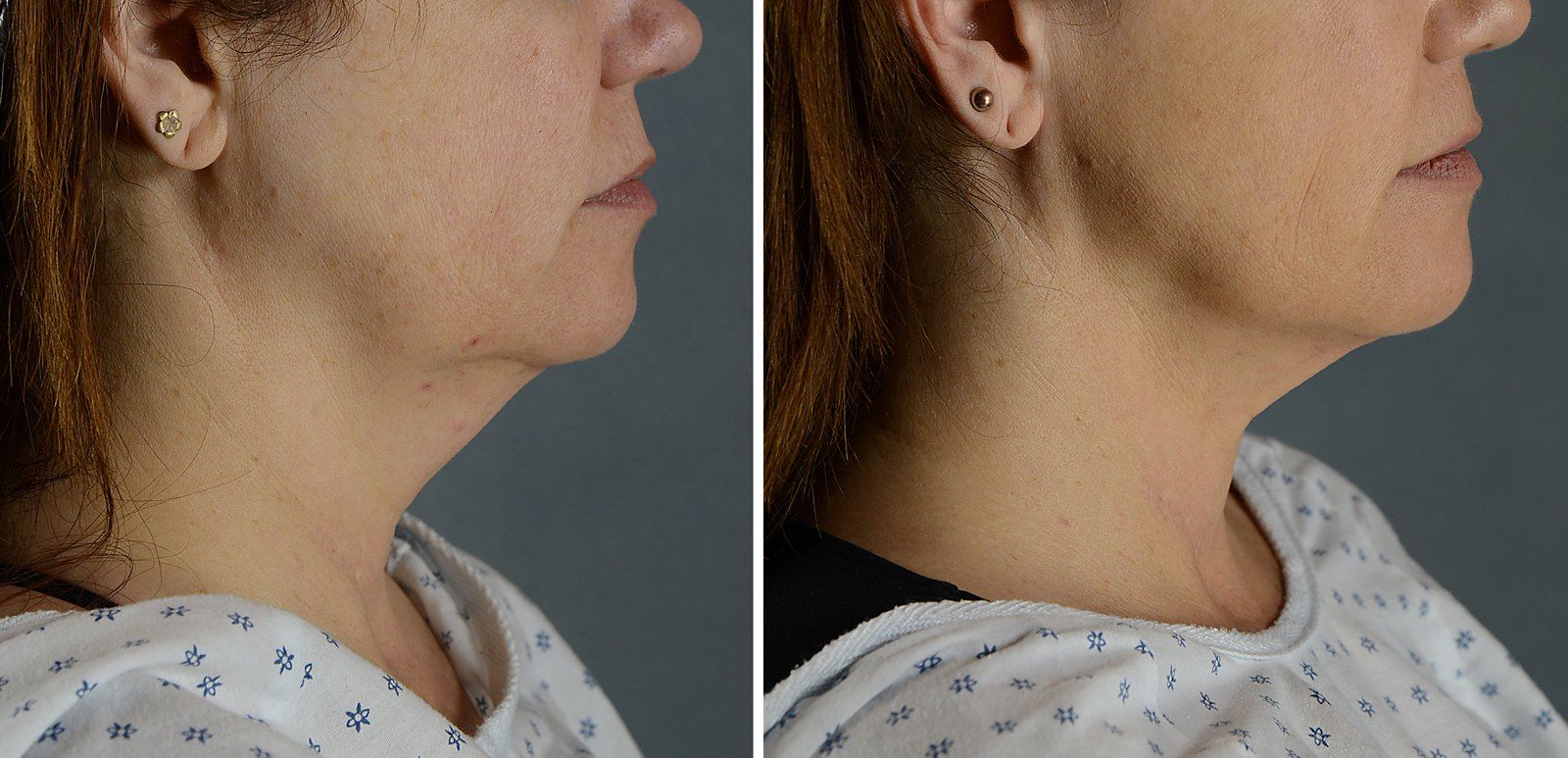 Before and after SenzaLipo: Chin & neck. Before on the left, after on the right.