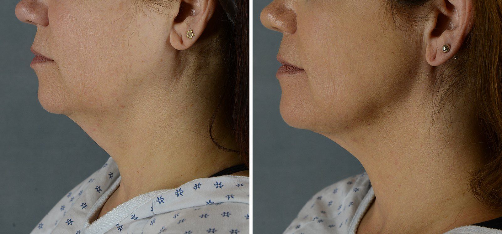 Before and after SenzaLipo: Chin & neck. Before on the left, after on the right.