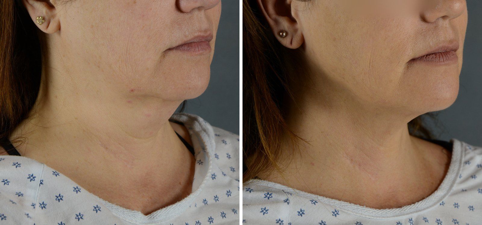Before and after SenzaLipo: Chin & neck. Before on the left, after on the right.
