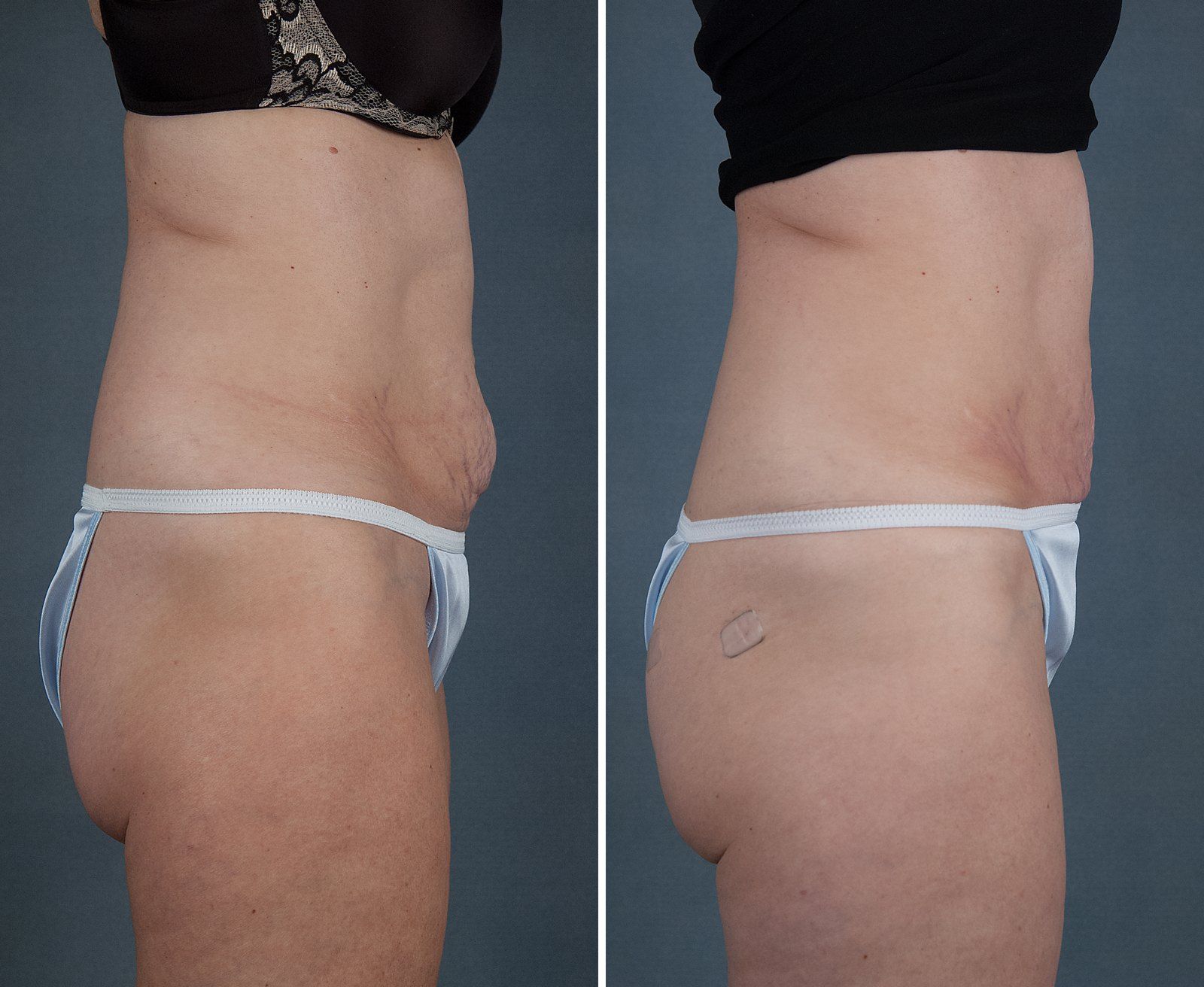 Before and after SenzaLipo: Abdomen. Before on the left, after on the right.