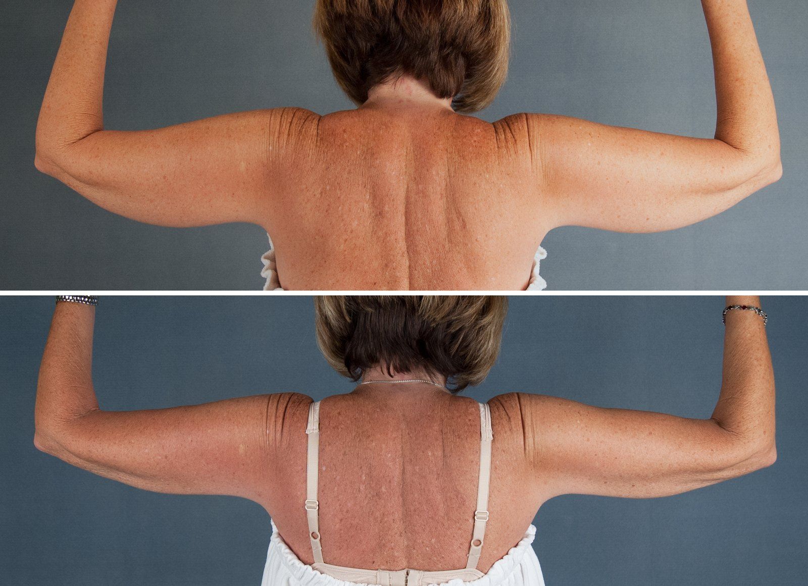Before and after SenzaLipo: Upper arms. Before on the left, after on the right.