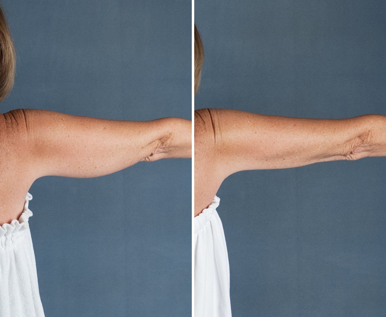 Before and after SenzaLipo: Upper arms. Before on the left, after on the right.