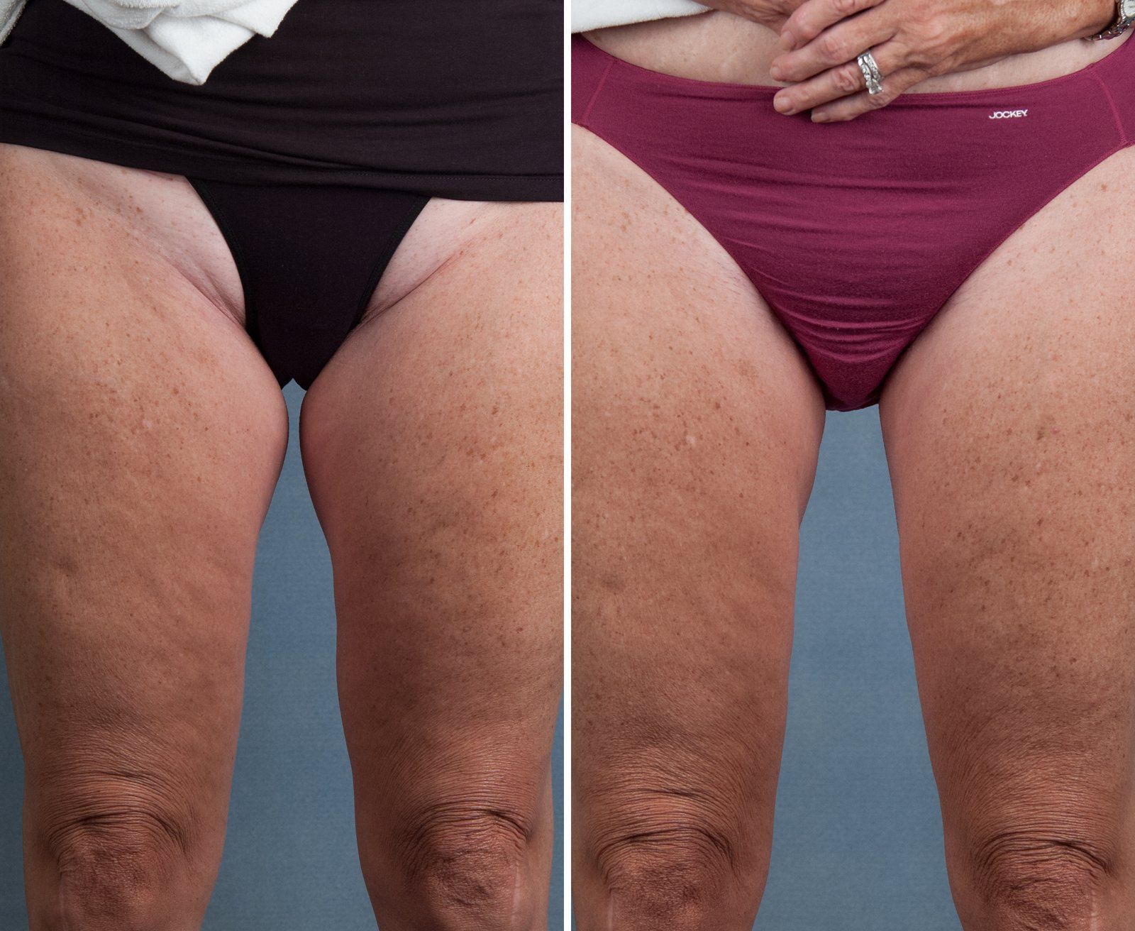 Before and after SenzaLipo: Thighs. Before on the left, after on the right.