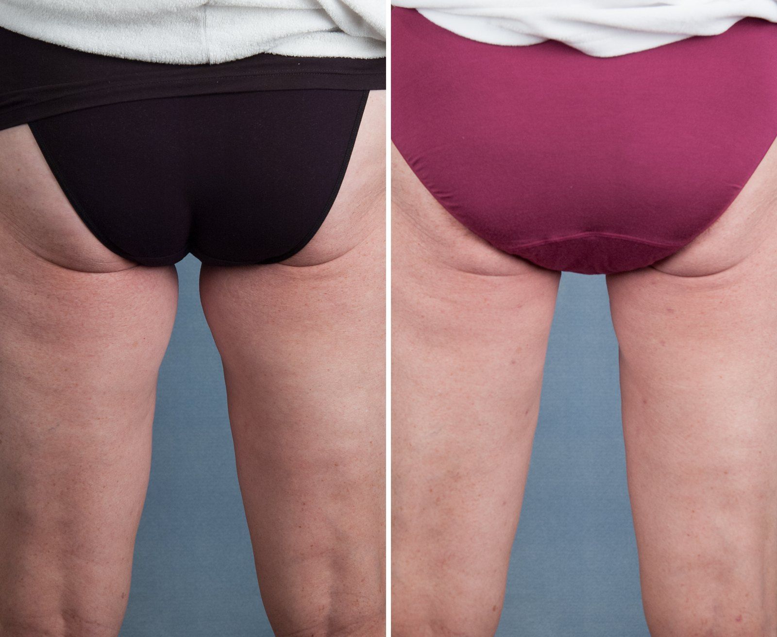Before and after SenzaLipo: Thighs. Before on the left, after on the right.