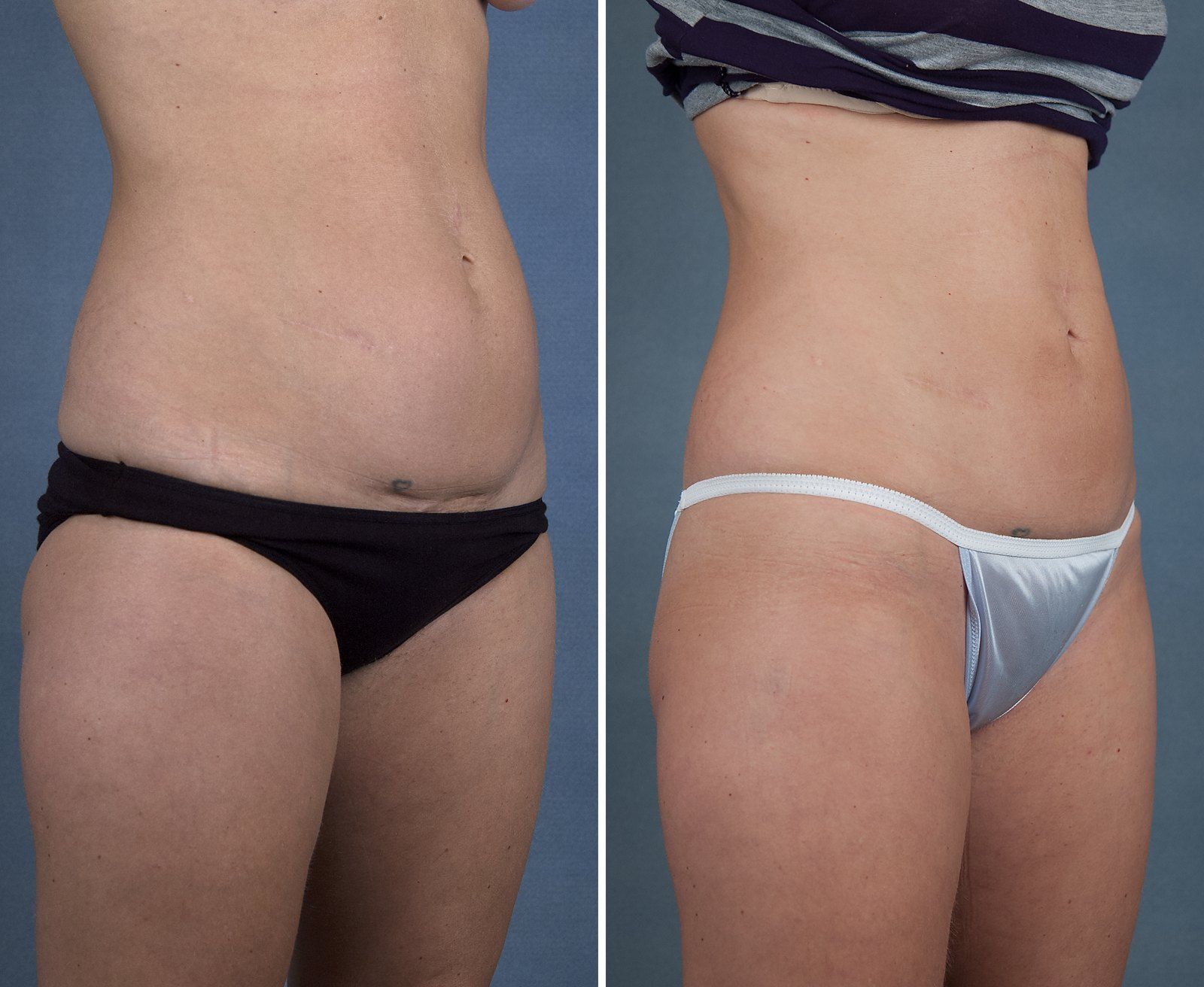 Before and after SenzaLipo: Abdomen. Before on the left, after on the right.