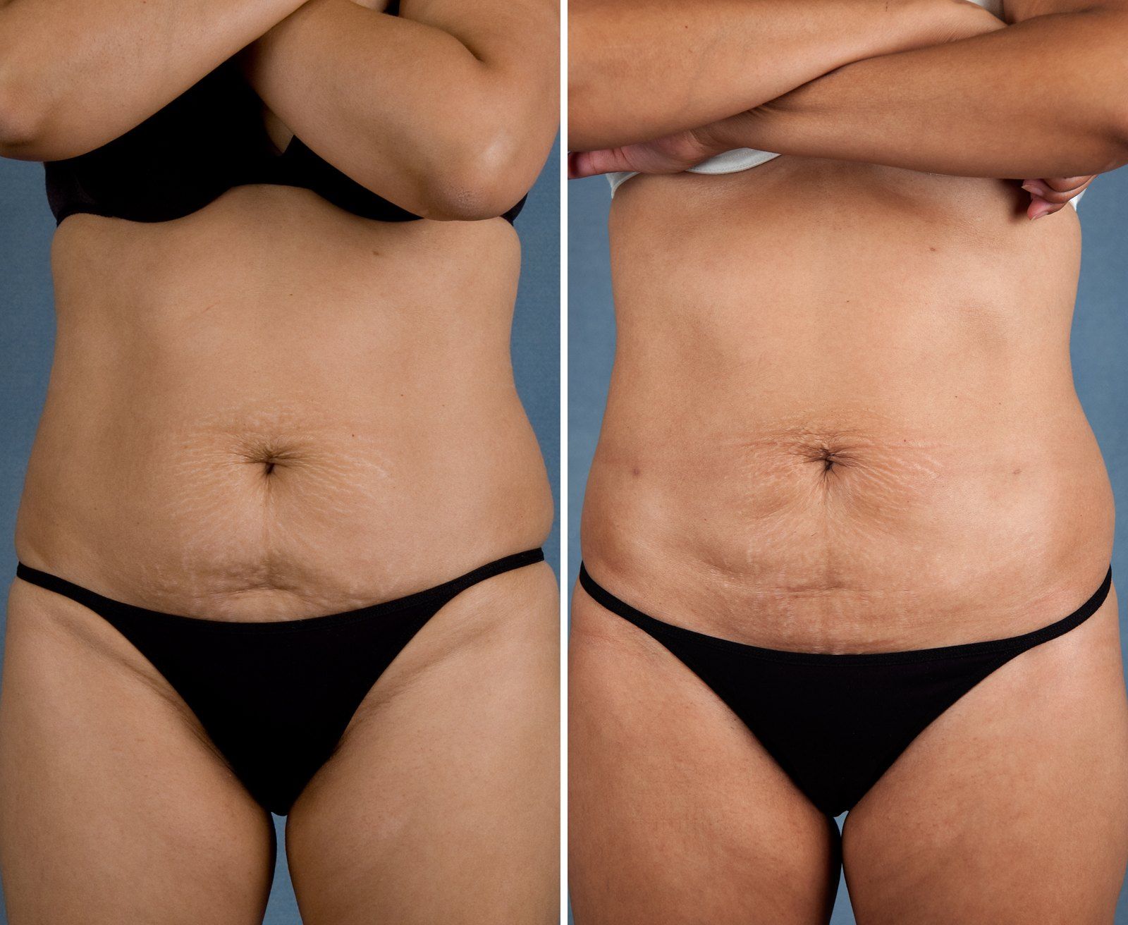 Before and after SenzaLipo: Abdomen. Before on the left, after on the right.