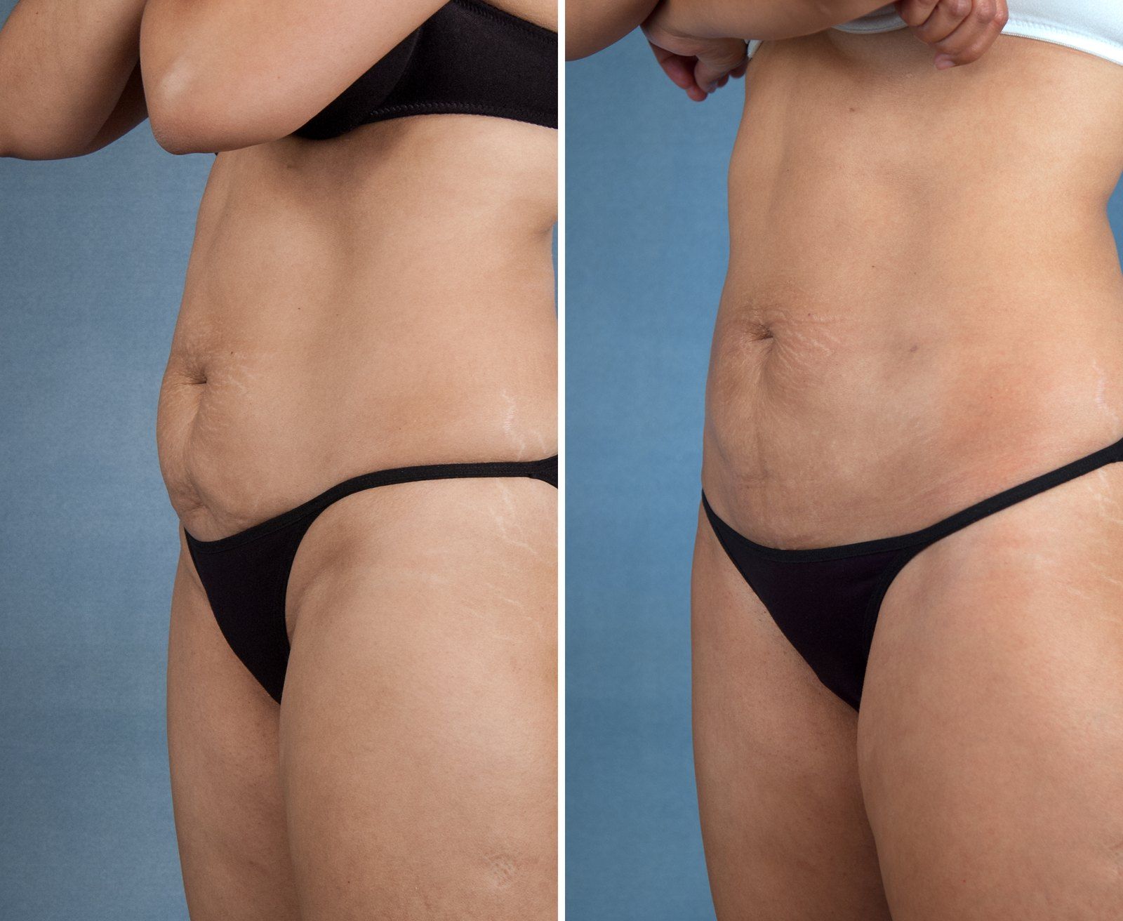 Before and after SenzaLipo: Abdomen. Before on the left, after on the right.