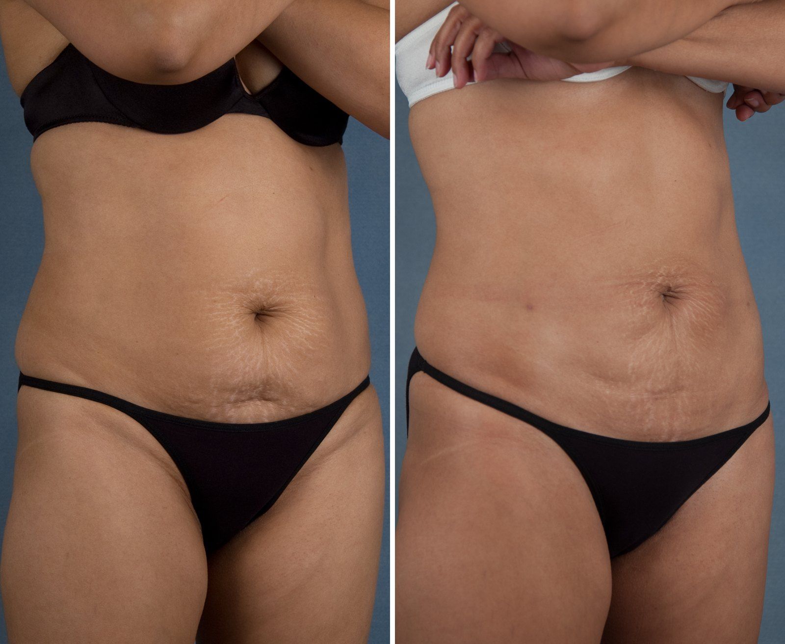 Before and after SenzaLipo: Abdomen. Before on the left, after on the right.