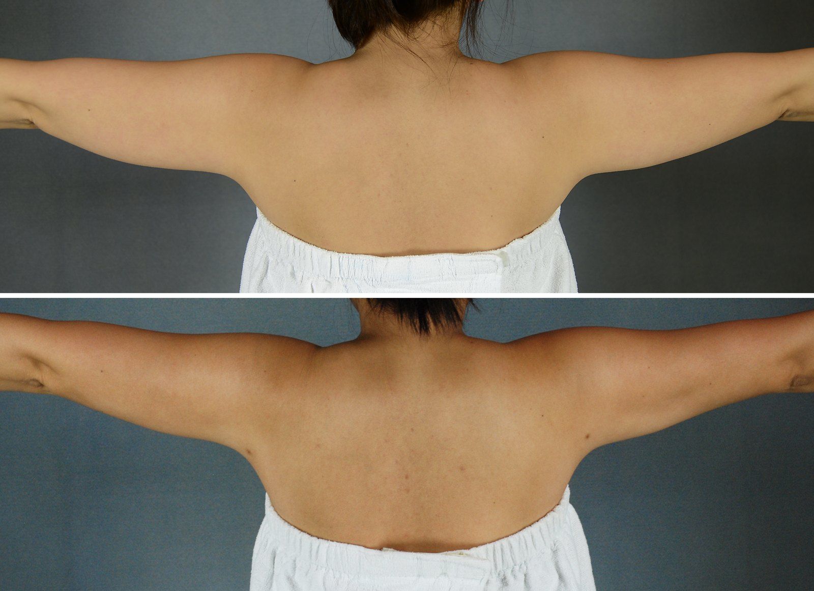 Before and after SenzaLipo: Upper arms. Before on the left, after on the right.