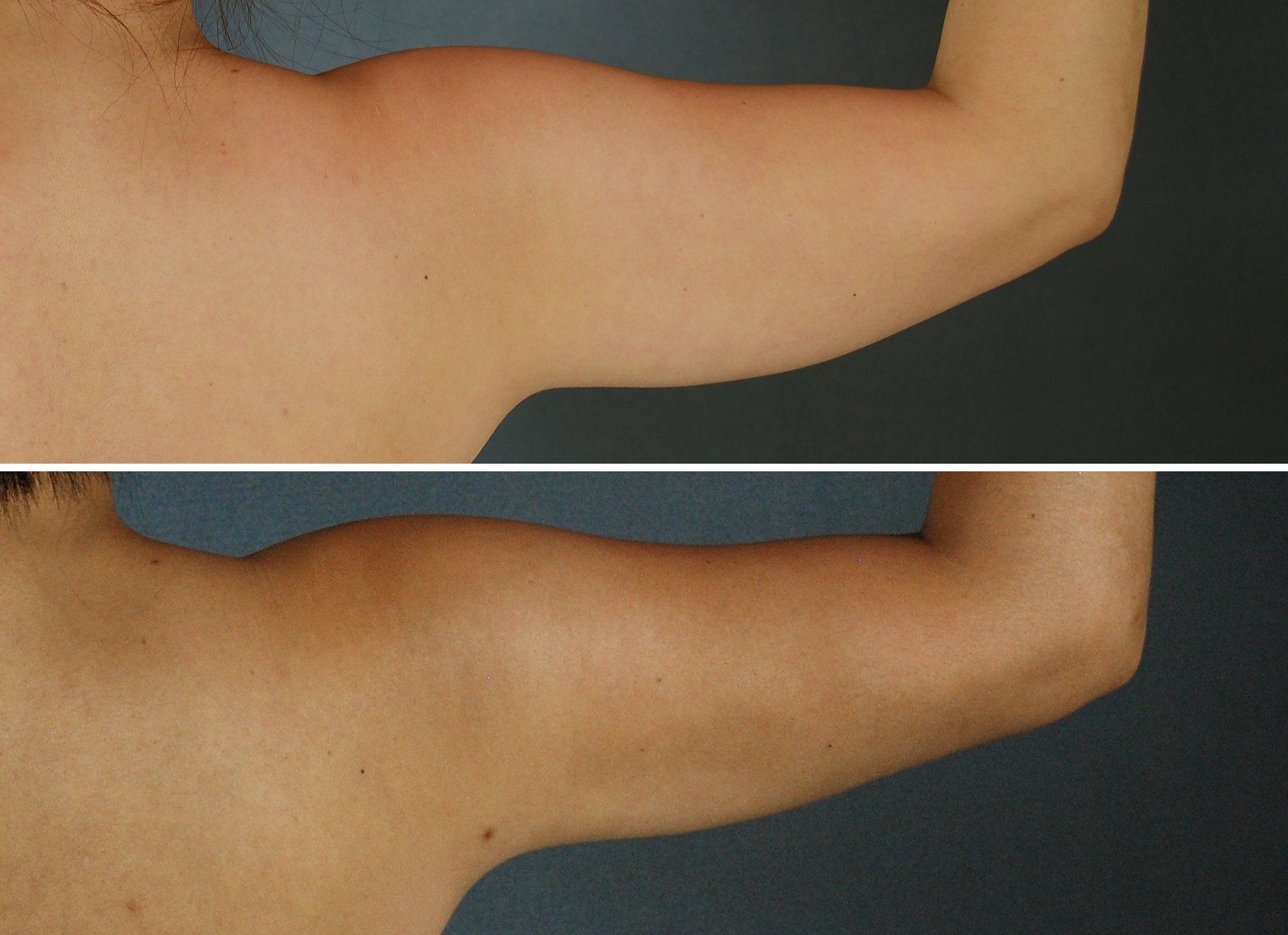 Before and after SenzaLipo: Upper arms. Before on the left, after on the right.