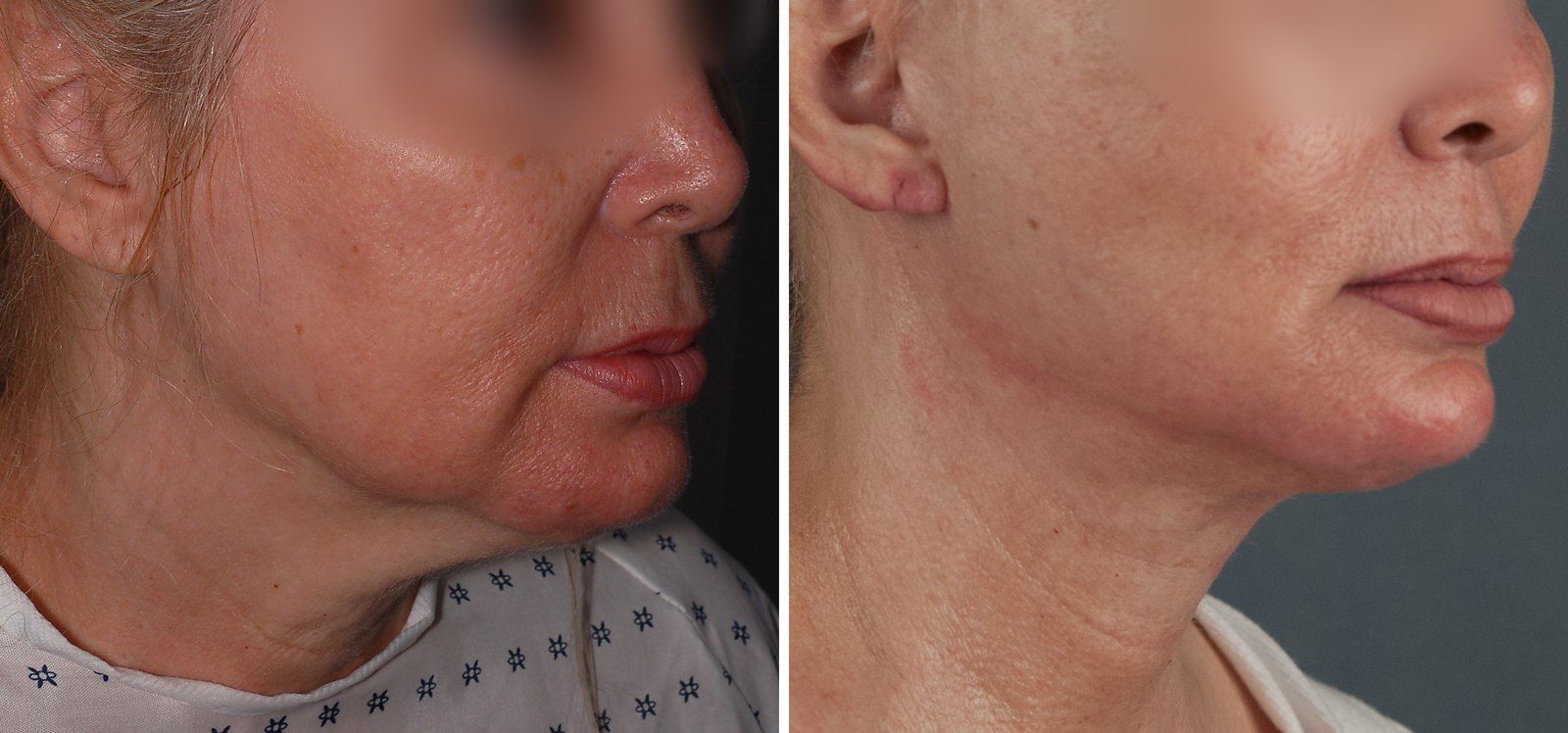 Before and after SenzaLipo: Neck & jawline. Before on the left, after on the right.
