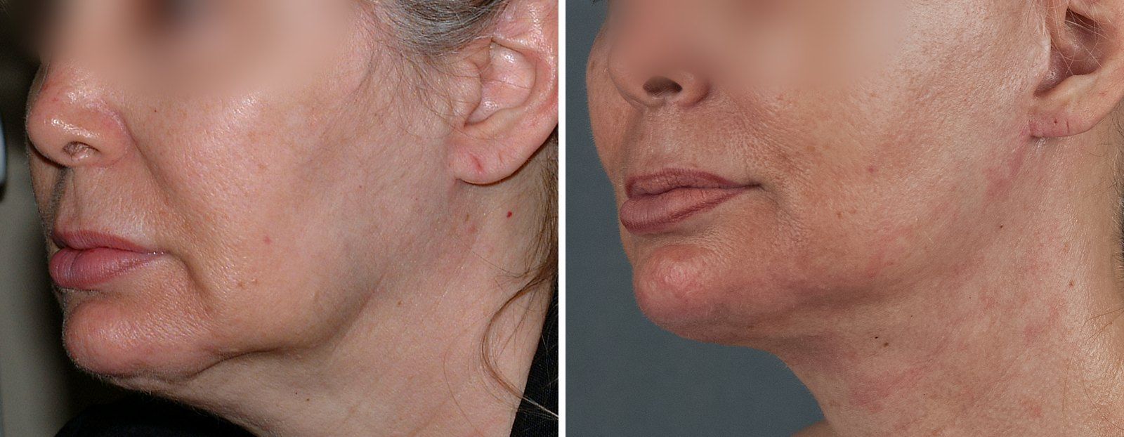 Before and after SenzaLipo: Neck & jawline. Before on the left, after on the right.