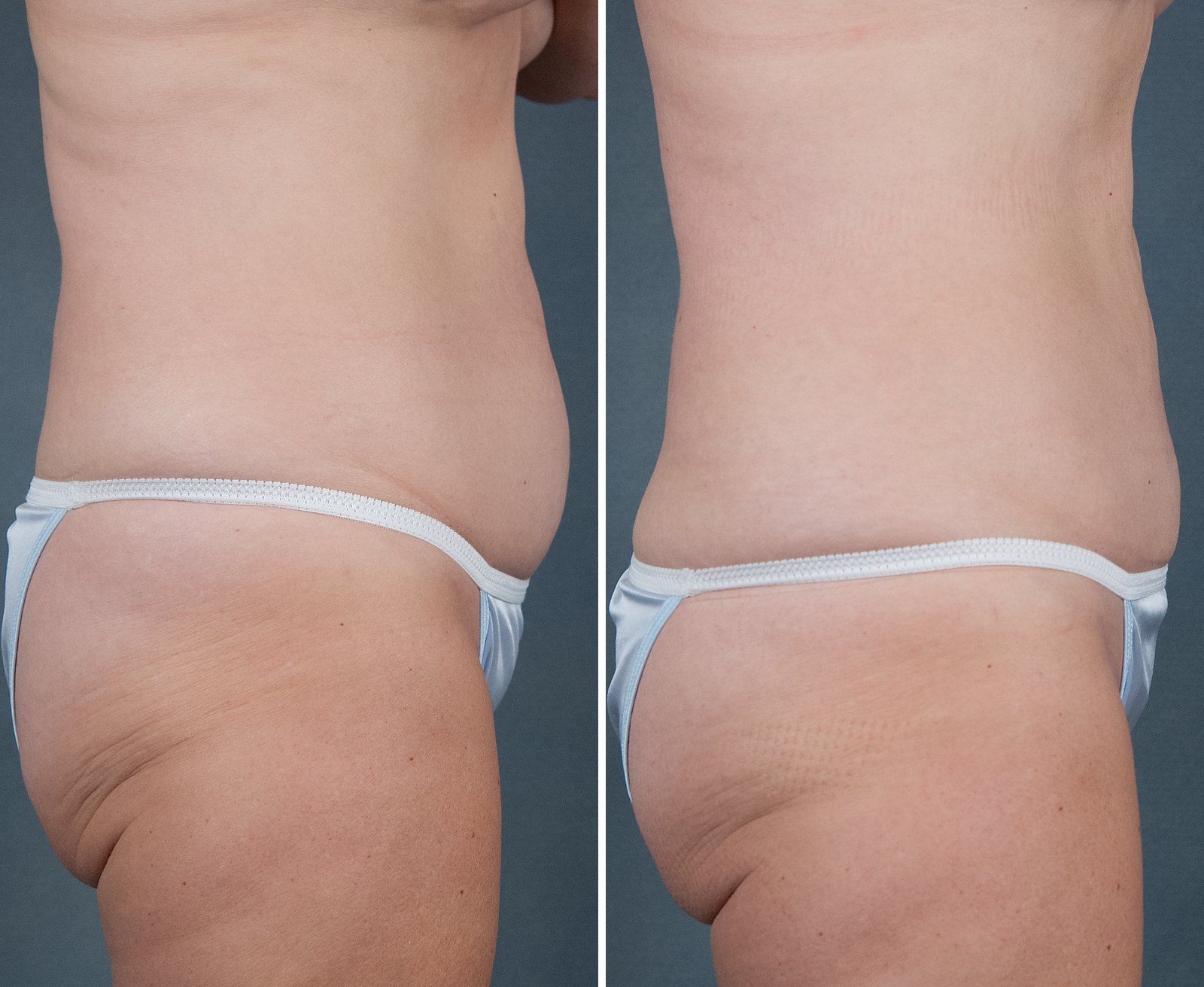 Before and after SenzaLipo: Abdomen & flanks. Before on the left, after on the right.