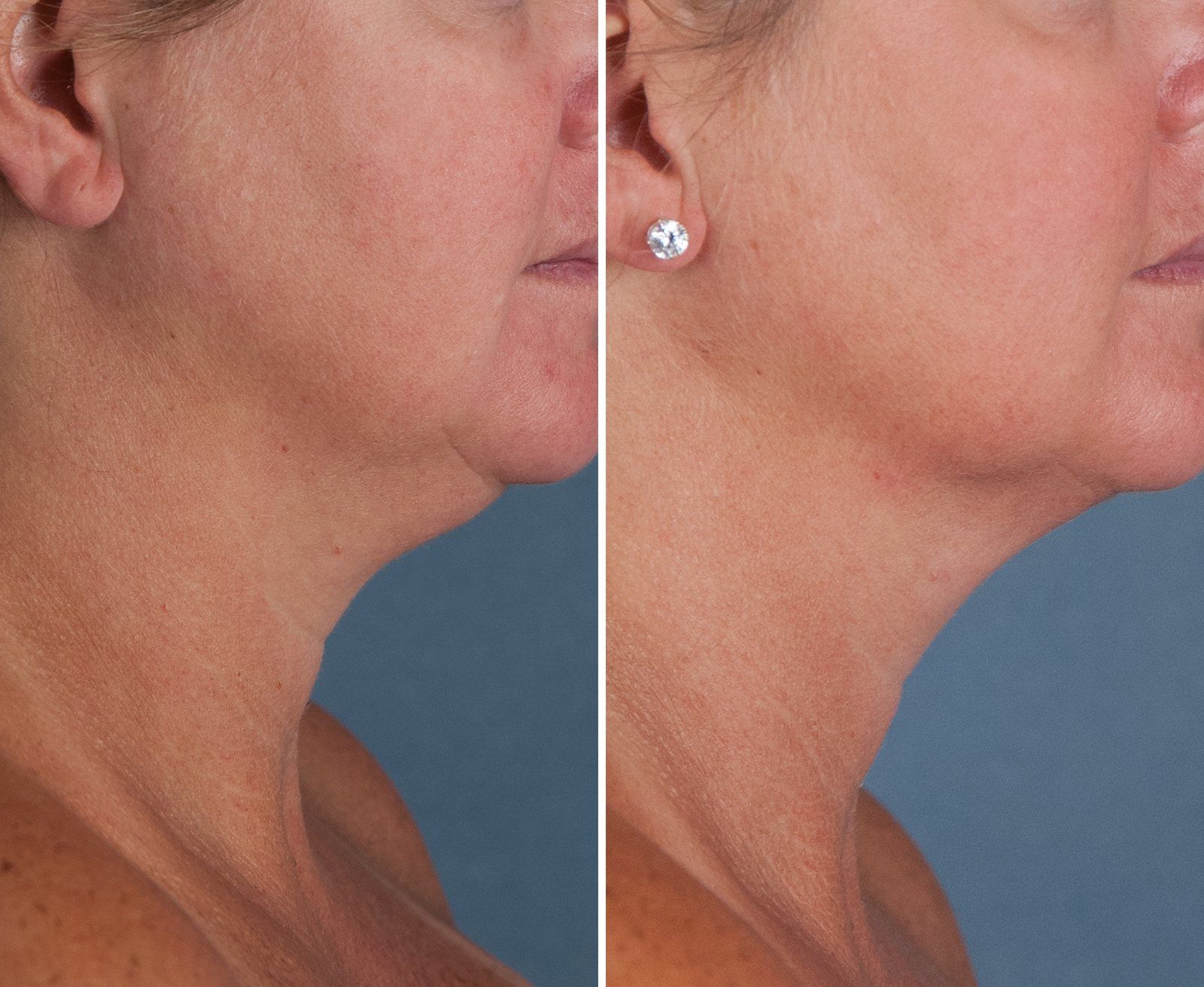 Before and after SenzaLipo: Chin & neck. Before on the left, after on the right.