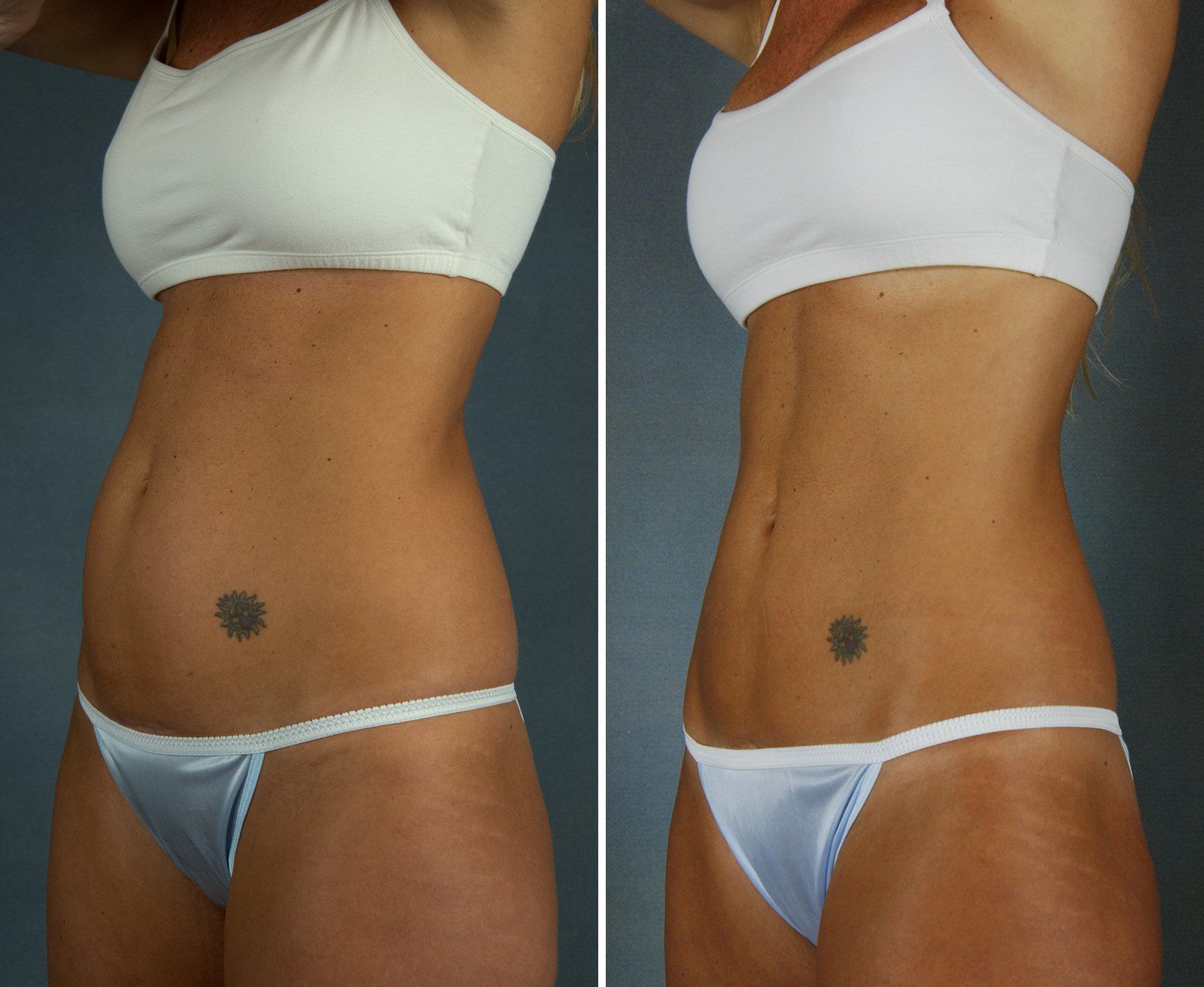 Before and after SenzaLipo: Abdomen. Before on the left, after on the right.