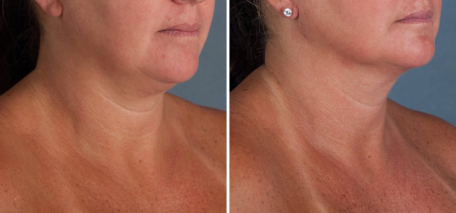 Before and after SenzaLipo: Chin & neck. Before on the left, after on the right.