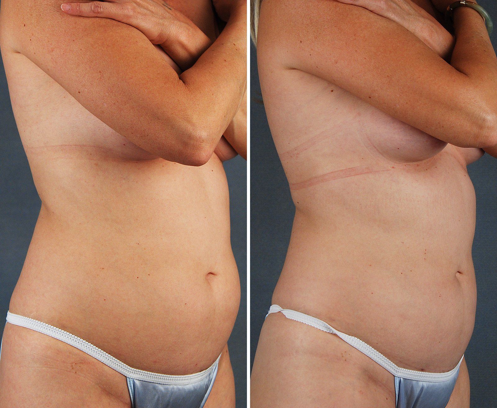 Before and after SenzaLipo: Abdomen. Before on the left, after on the right.