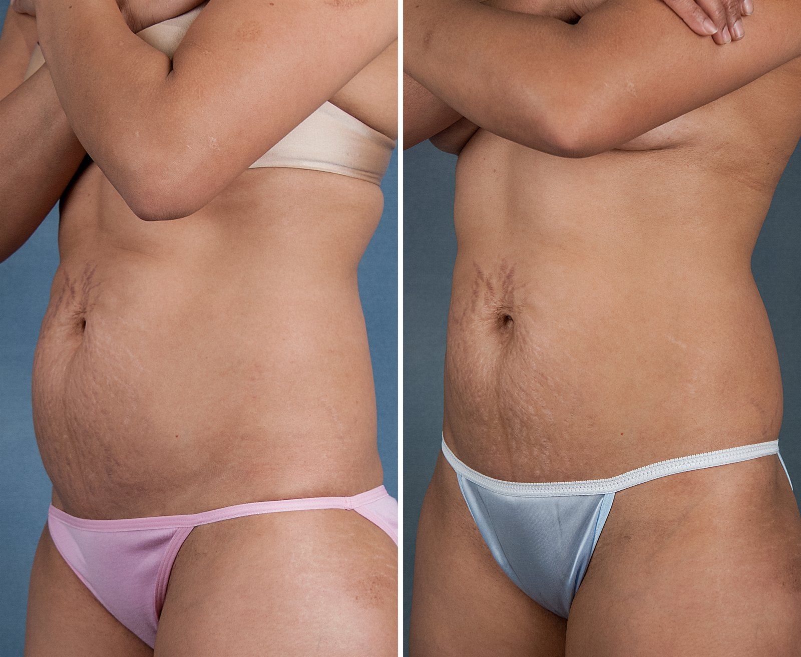 Before and after SenzaLipo: Abdomen. Before on the left, after on the right.