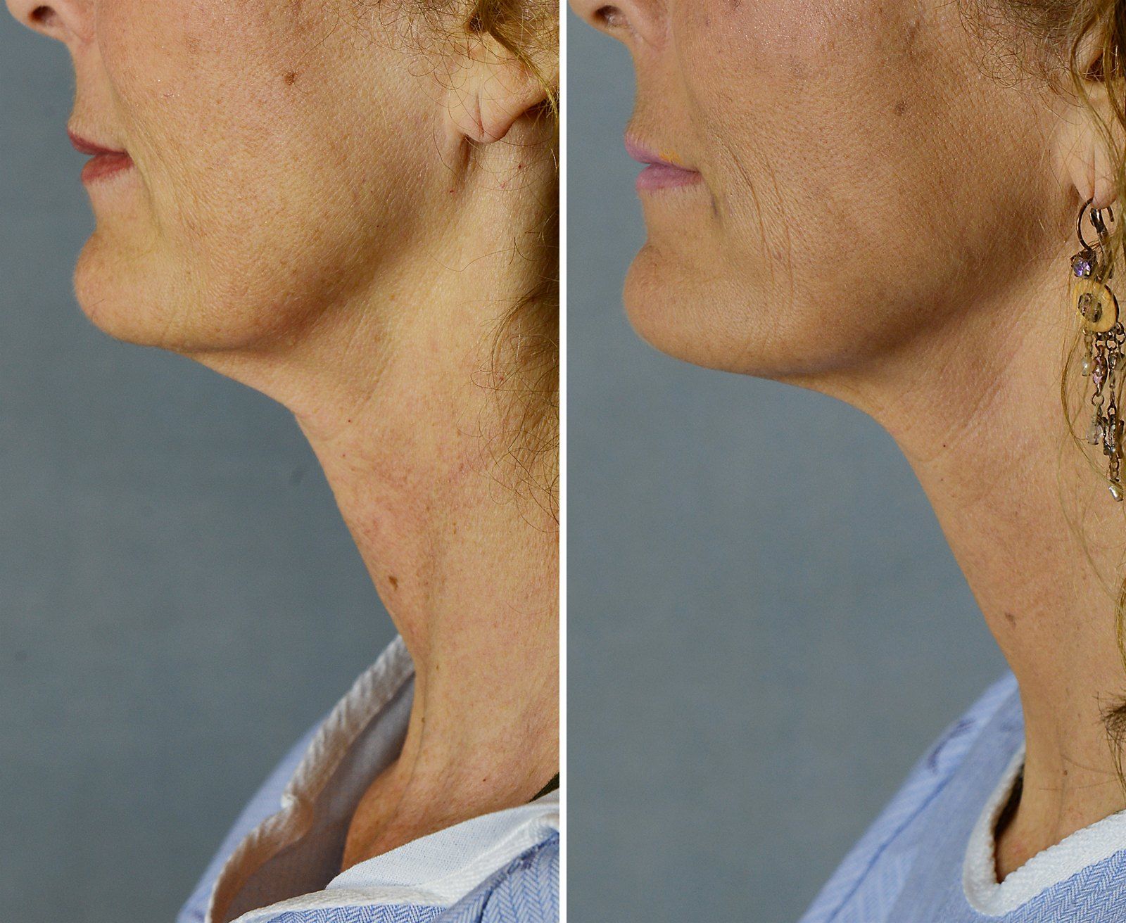 Before and after SenzaLipo: Chin & neck. Before on the left, after on the right.