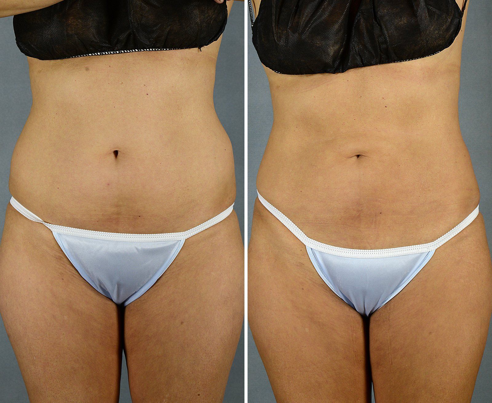 Before and after SenzaLipo: Abdomen. Before on the left, after on the right.