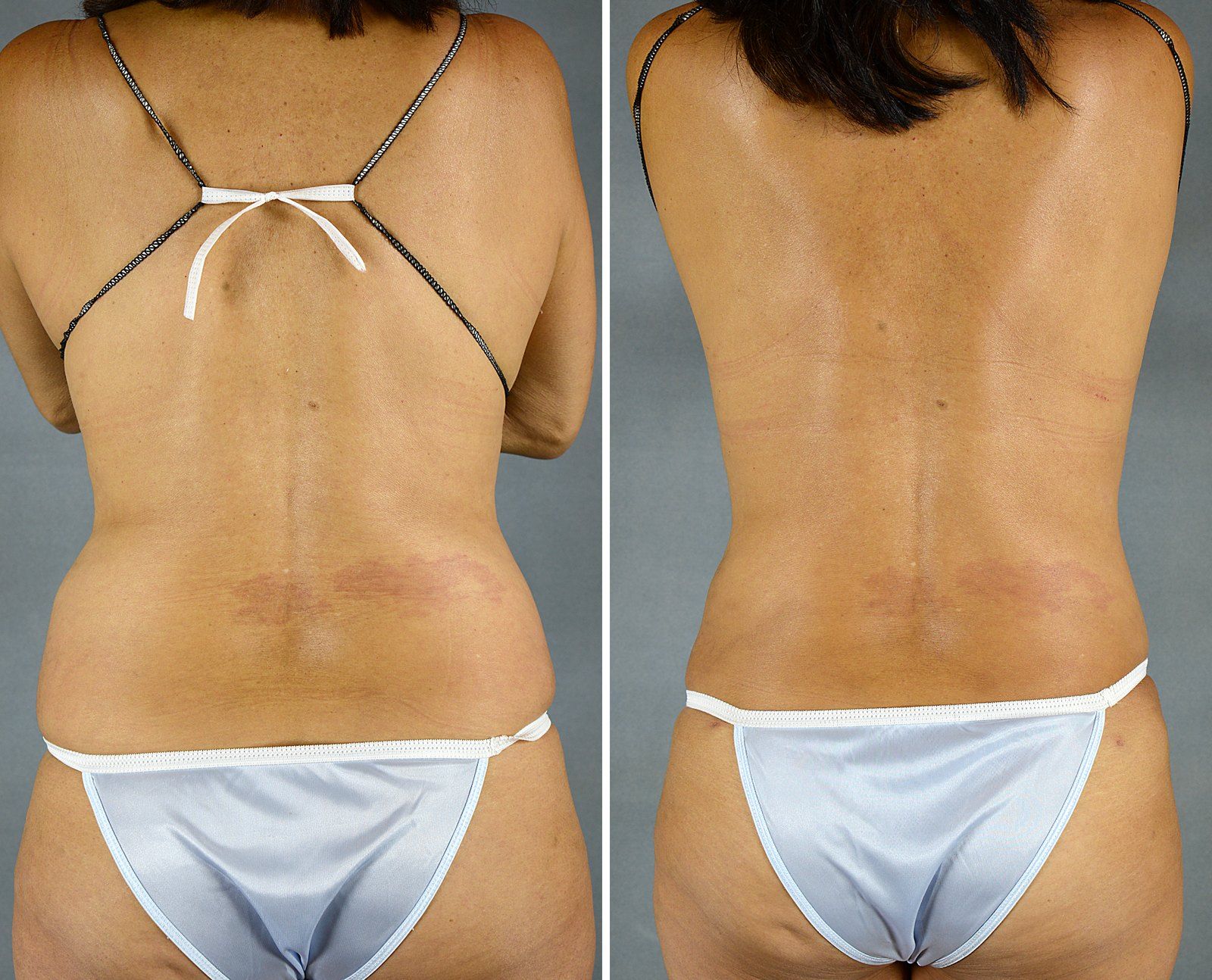 Before and after SenzaLipo: Back & flanks. Before on the left, after on the right.