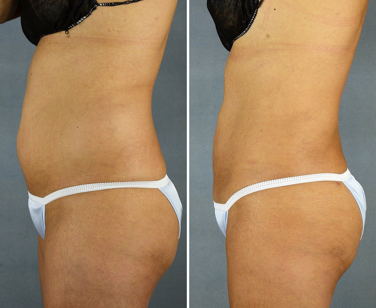 Before and after SenzaLipo: Abdomen & flanks. Before on the left, after on the right.
