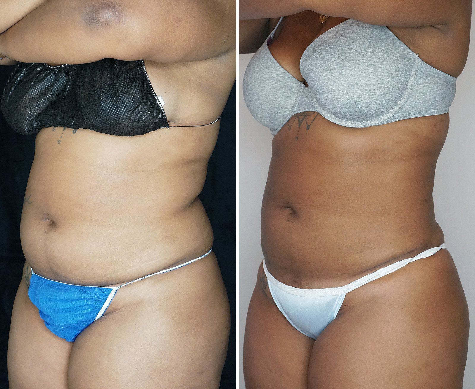 Before and after SenzaLipo: Abdomen & flanks. Before on the left, after on the right.