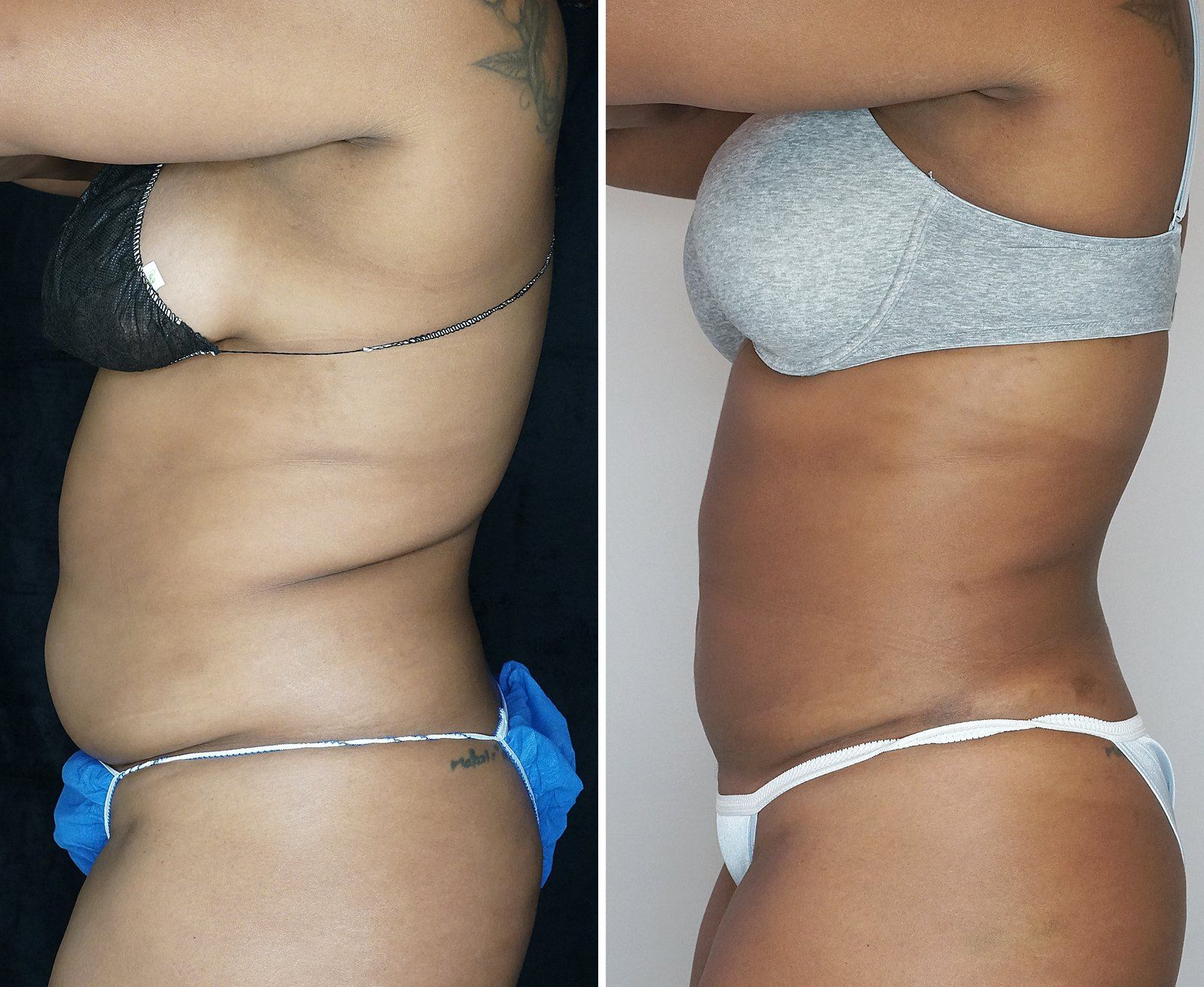 Before and after SenzaLipo: Abdomen & flanks. Before on the left, after on the right.
