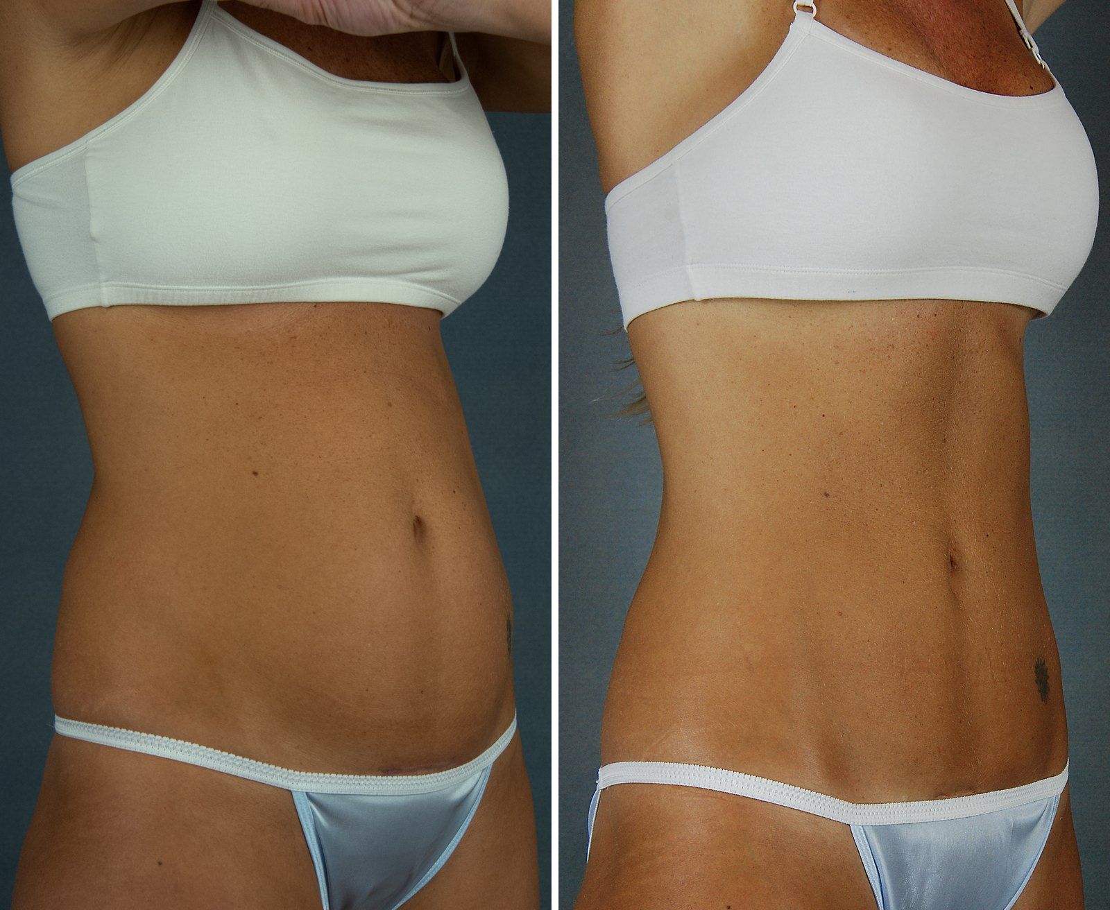 Before and after SenzaLipo: Abdomen & waist. Before on the left, after on the right.