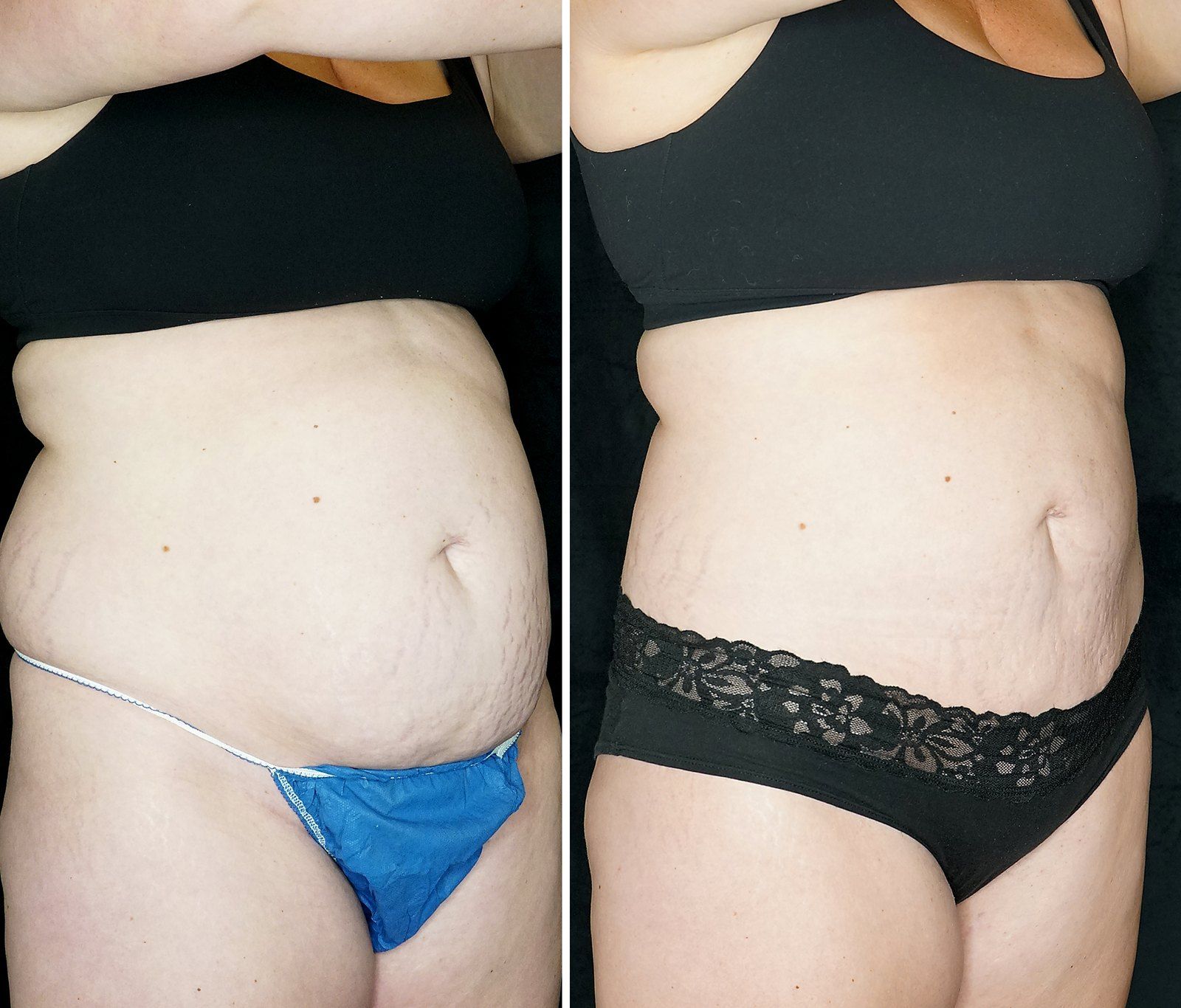 Before and after SenzaLipo: Abdomen. Before on the left, after on the right.