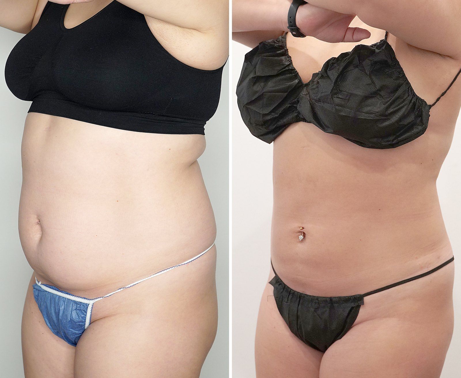 Before and after SenzaLipo: Abdomen. Before on the left, after on the right.