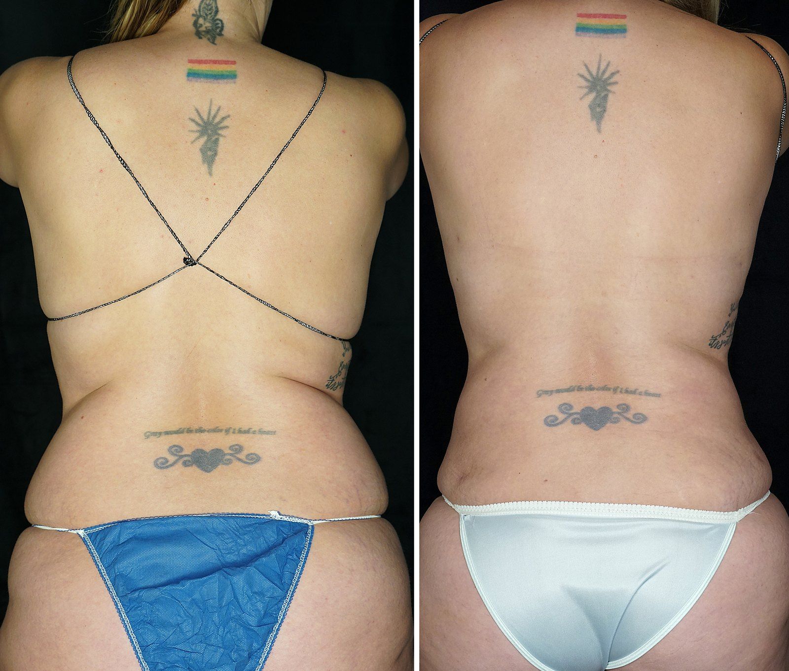 Before and after SenzaLipo: Back & flanks. Before on the left, after on the right.