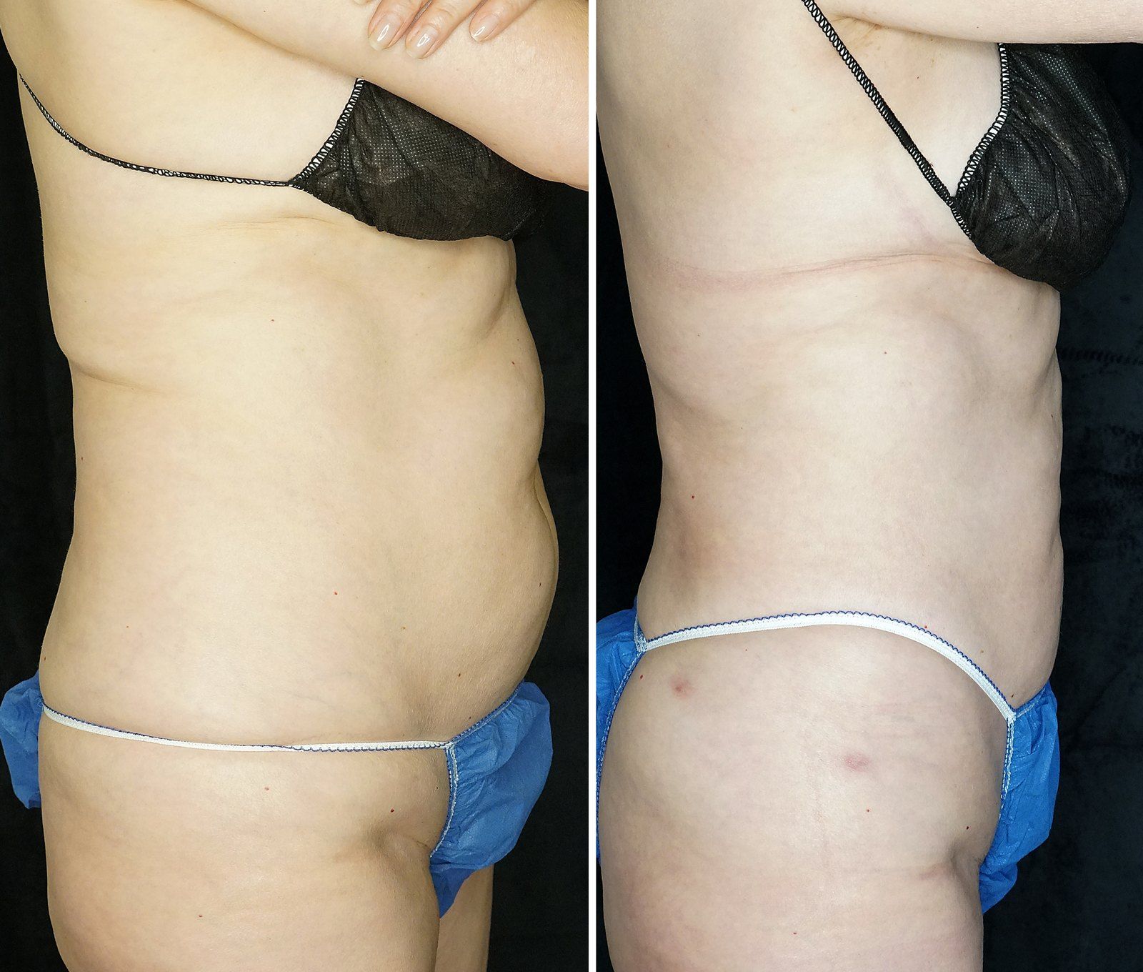Before and after SenzaLipo: Abdomen & flanks. Before on the left, after on the right.