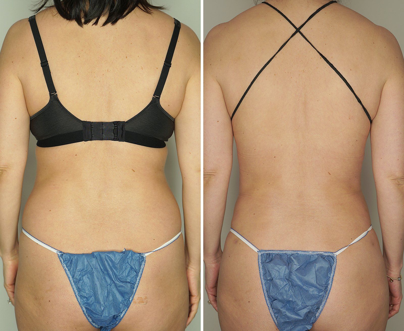 Before and after SenzaLipo: Back. Before on the left, after on the right.