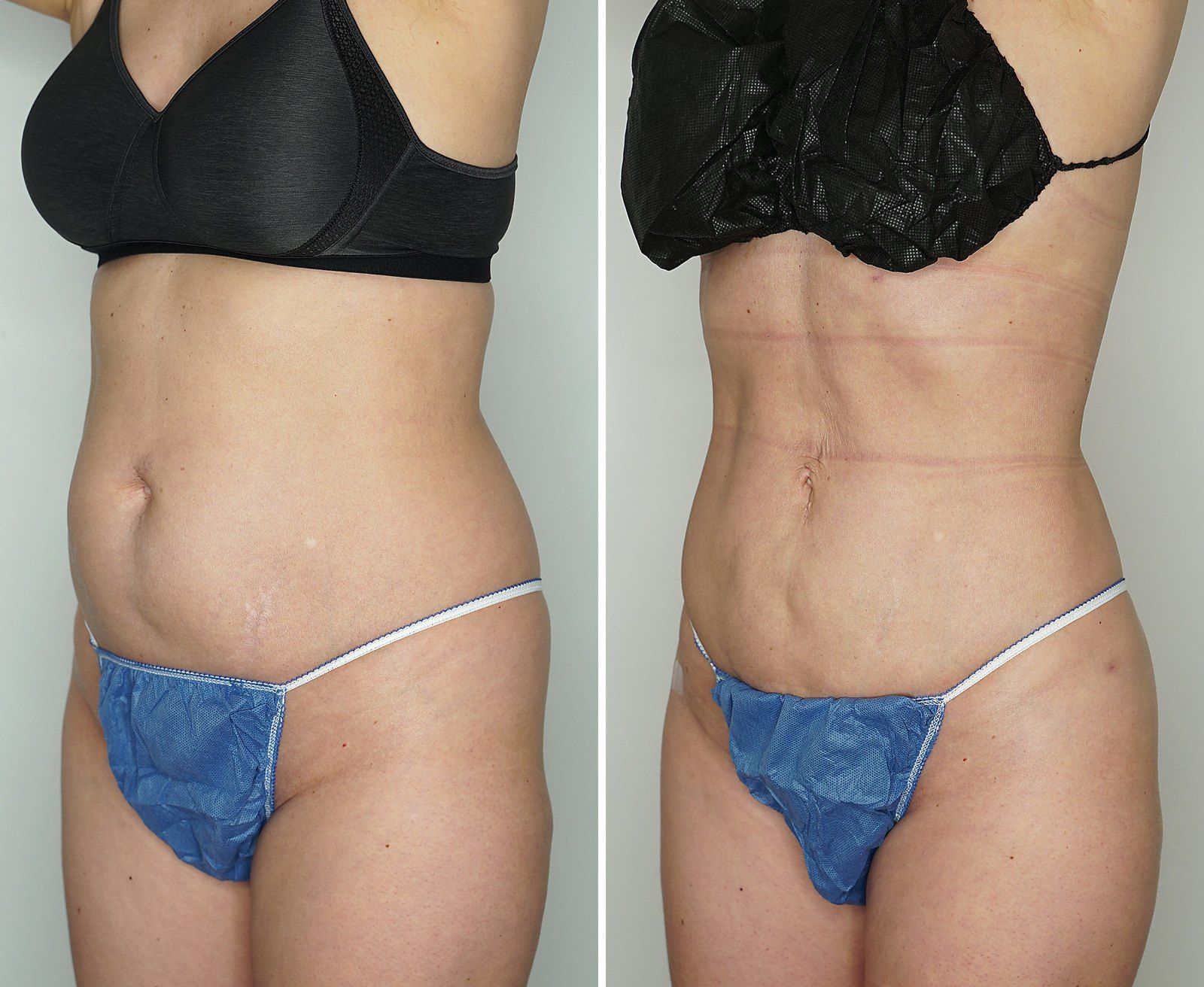 Before and after SenzaLipo: Abdomen. Before on the left, after on the right.
