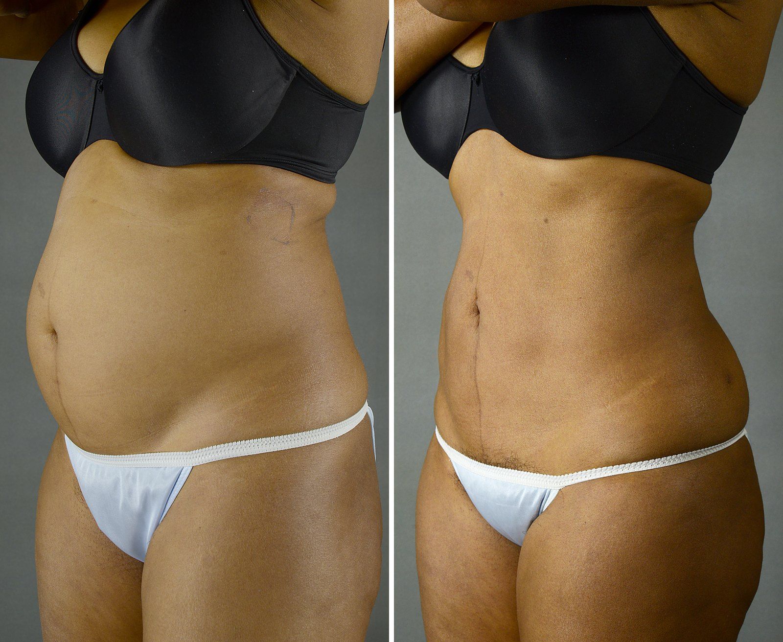 Before and after SenzaLipo: Abdomen. Before on the left, after on the right.