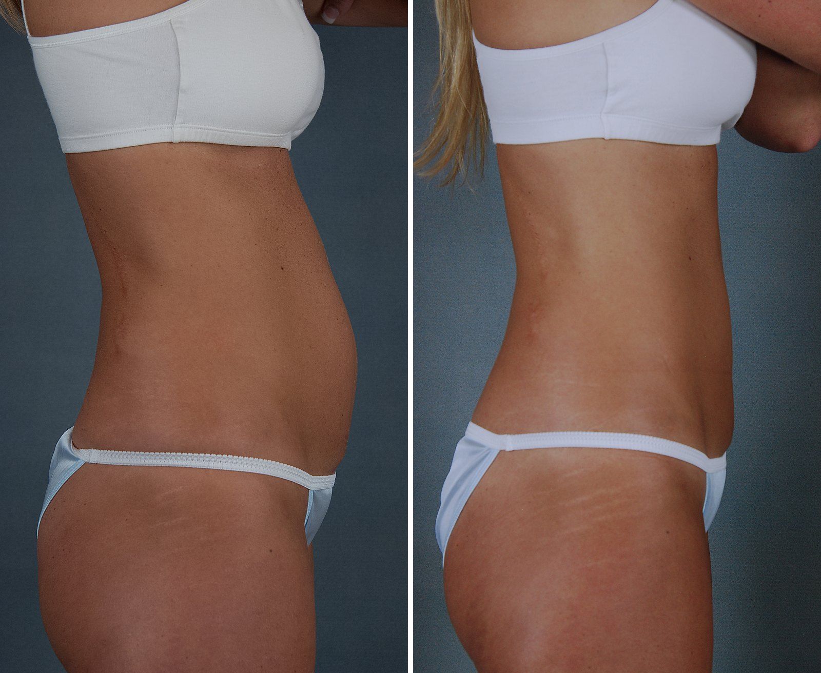 Before and after SenzaLipo: Abdomen. Before on the left, after on the right.