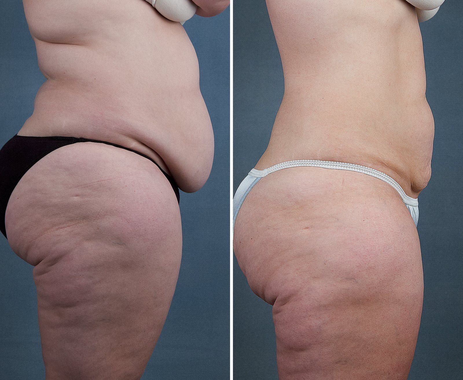 Before and after SenzaLipo: Abdomen & flanks. Before on the left, after on the right.
