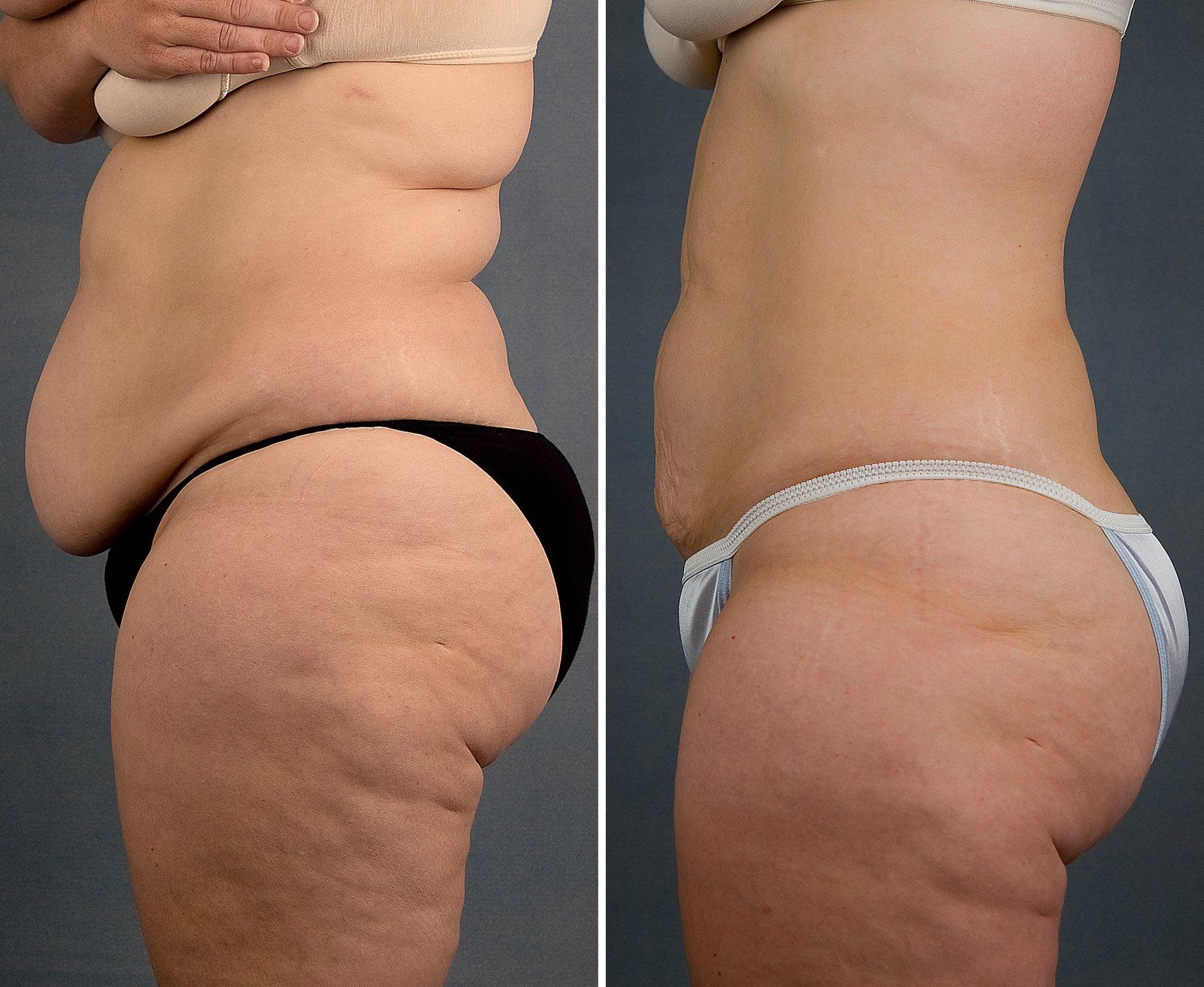 Before and after SenzaLipo: Abdomen & flanks. Before on the left, after on the right.