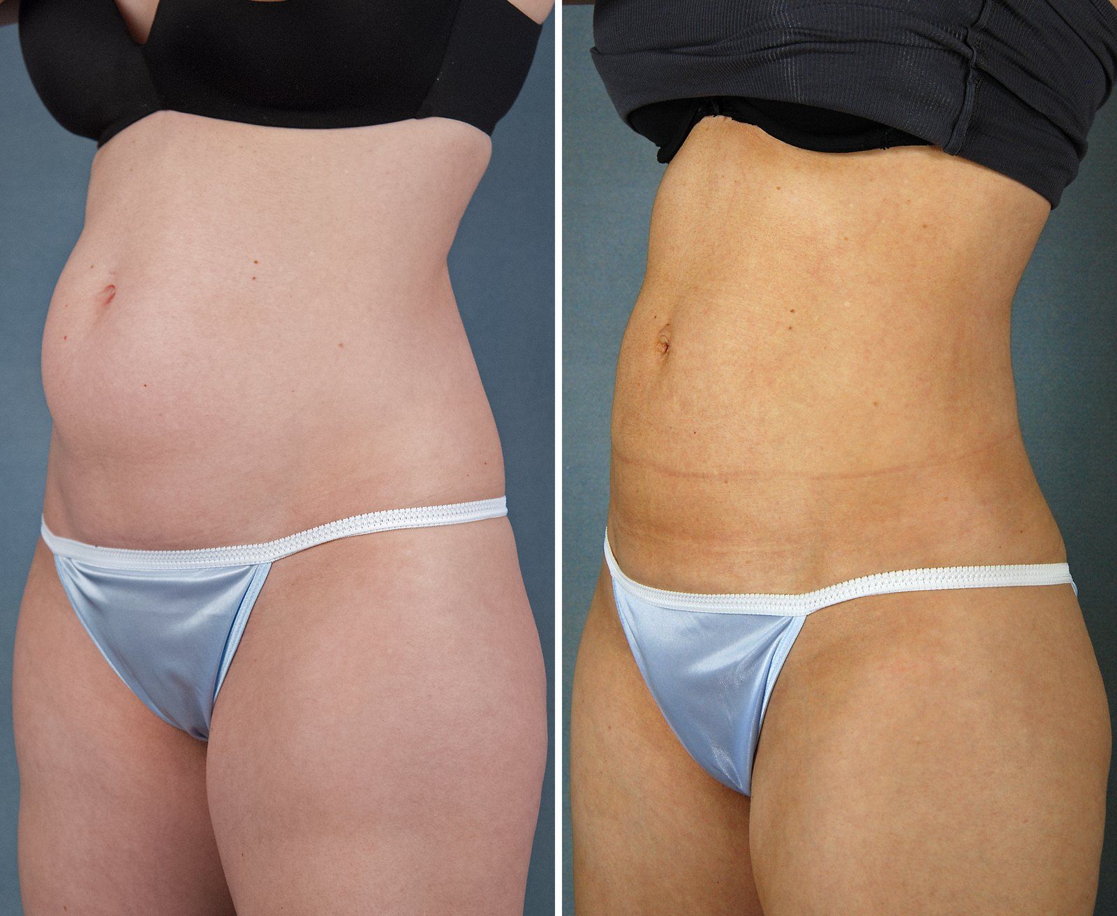 Before and after SenzaLipo: Abdomen. Before on the left, after on the right.